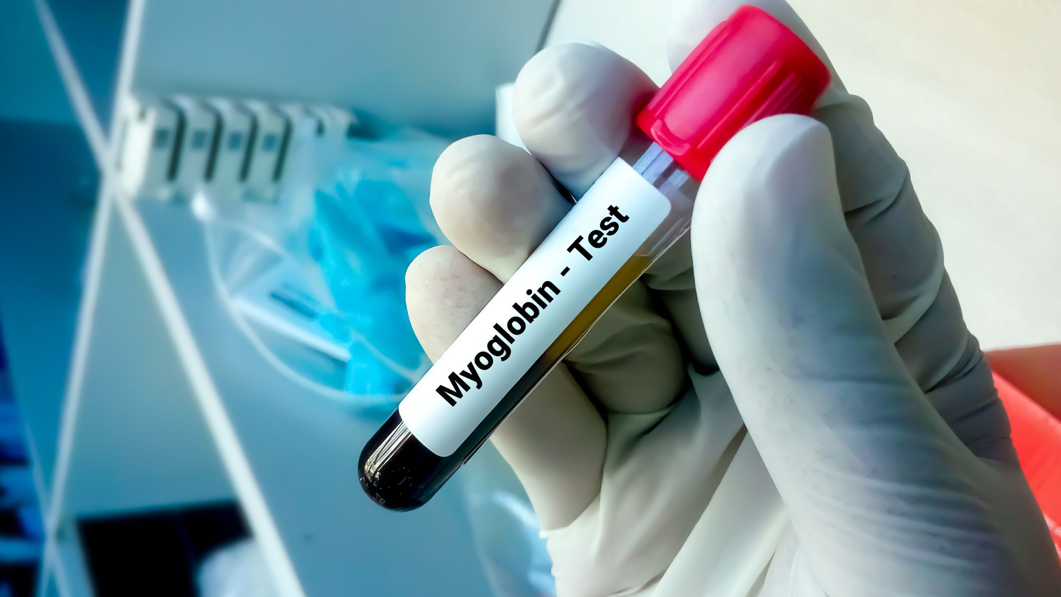 Xét nghiệm myoglobin hỗ trợ phát hiện sớm các tổn thương cơ