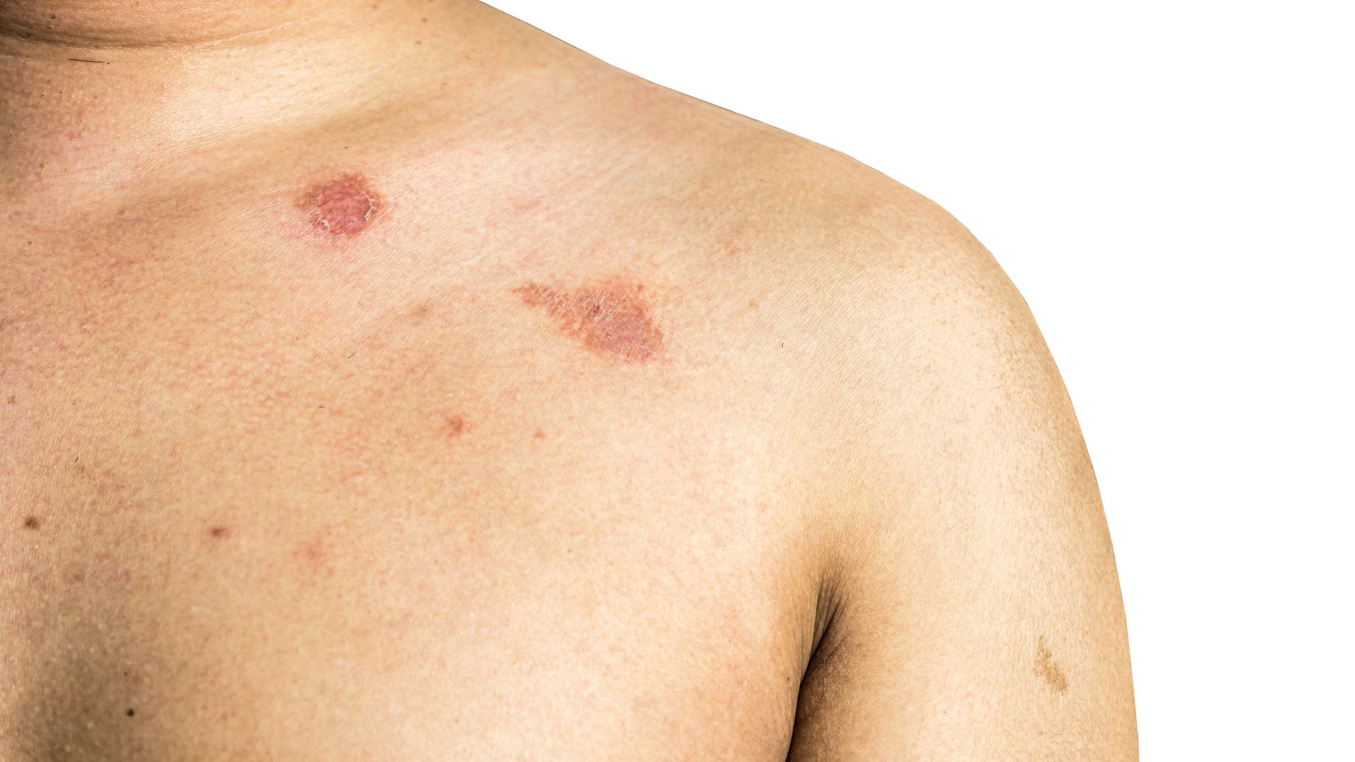 Người bệnh cần chú ý đến các mảng nổi không đều màu trên da