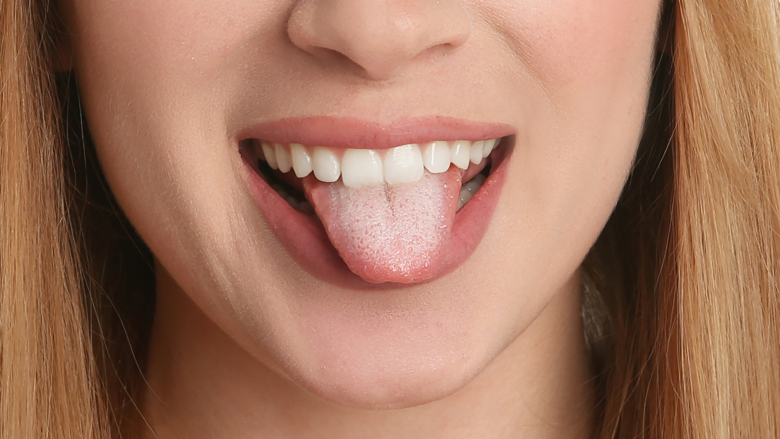 Các mảng trắng trong khoang miệng