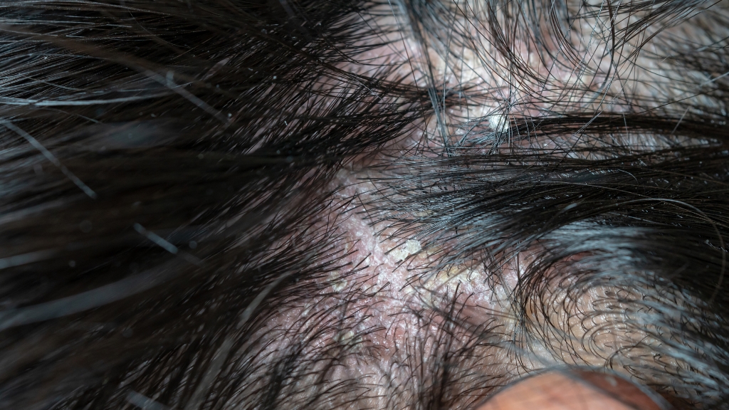 Tìm hiểu chi tiết nấm da đầu có gây rụng tóc không​