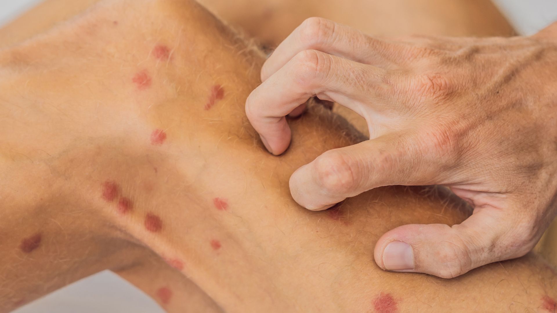 Nấm da đùi thường gây ra mảng đỏ, ngứa rát và dễ lan rộng nếu không chăm sóc đúng cách