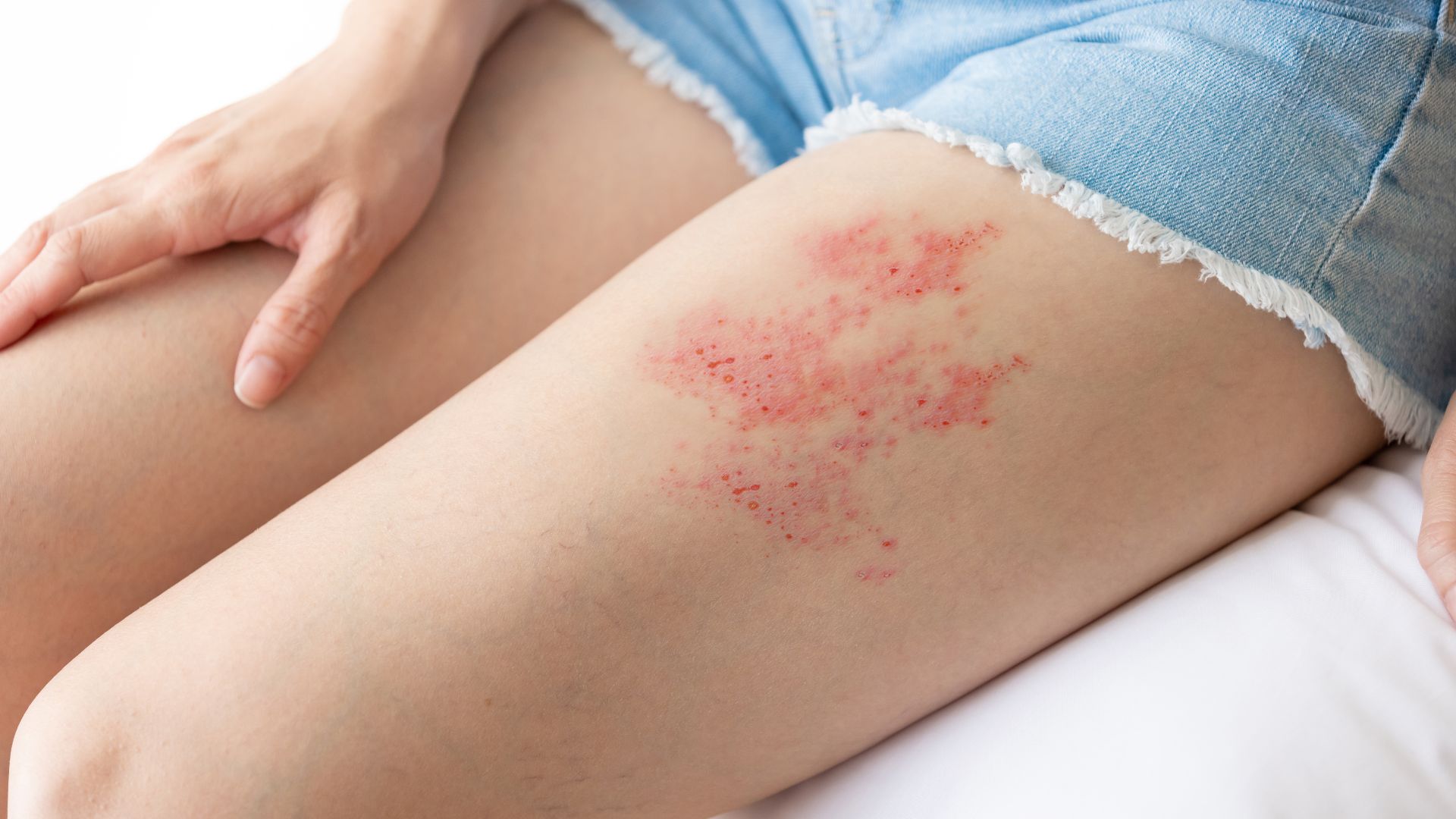 Nấm da đùi có thể tái phát nhiều lần nếu không giữ vệ sinh và chăm sóc đúng cách