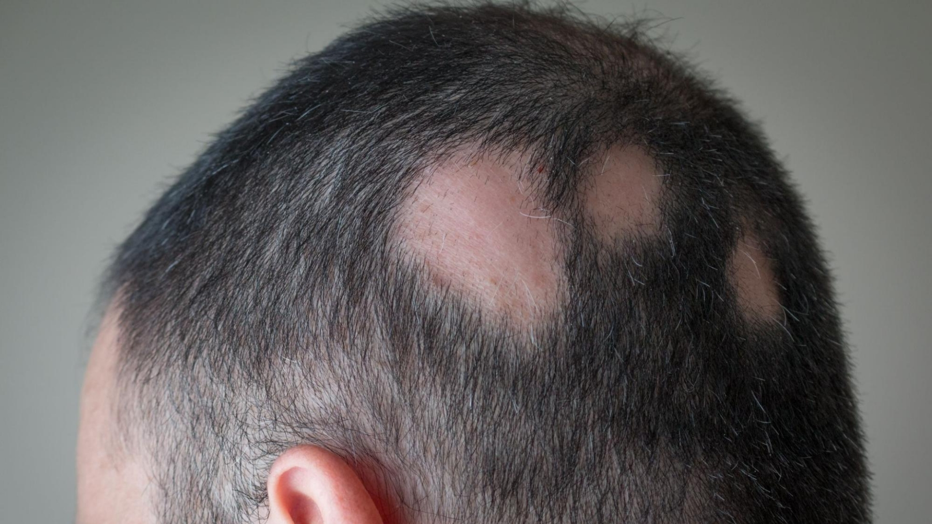 Xuất hiện các mảng da hình tròn hoặc bầu dục rõ rệt là dấu hiệu đặc trưng nhất của nhiễm nấm Microsporum