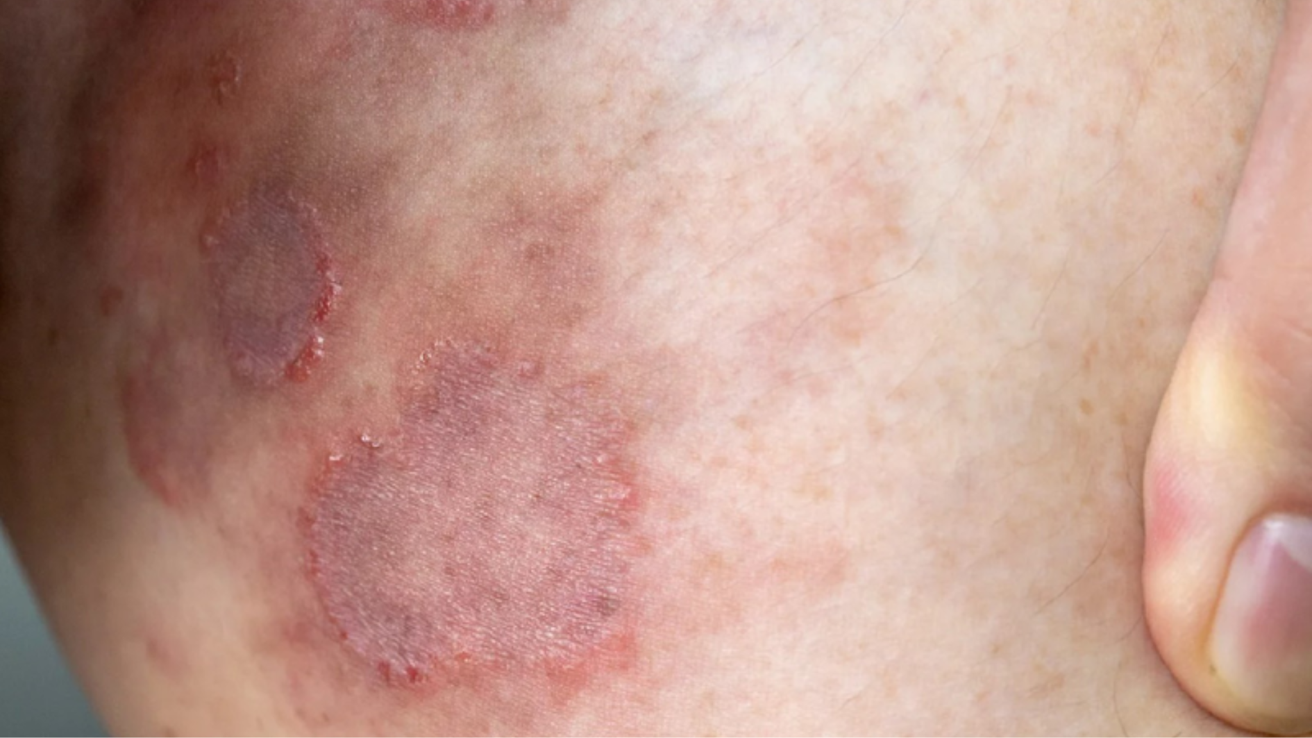 Nấm mông là bệnh lý da liễu do nhiều nguyên nhân gây ra