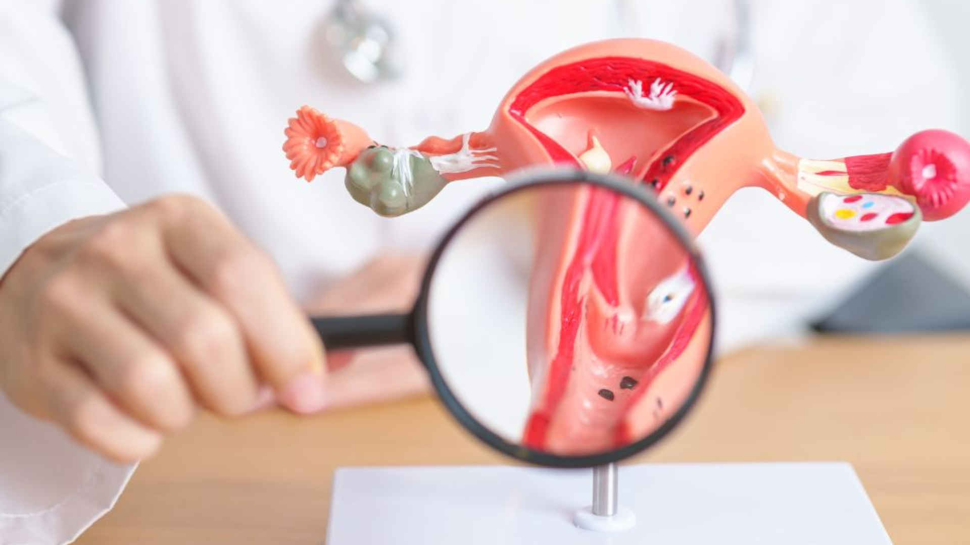 Nang Naboth cổ tử cung 11mm là tổn thương lành tính, quan sát dễ dàng, hầu hết không cần điều trị