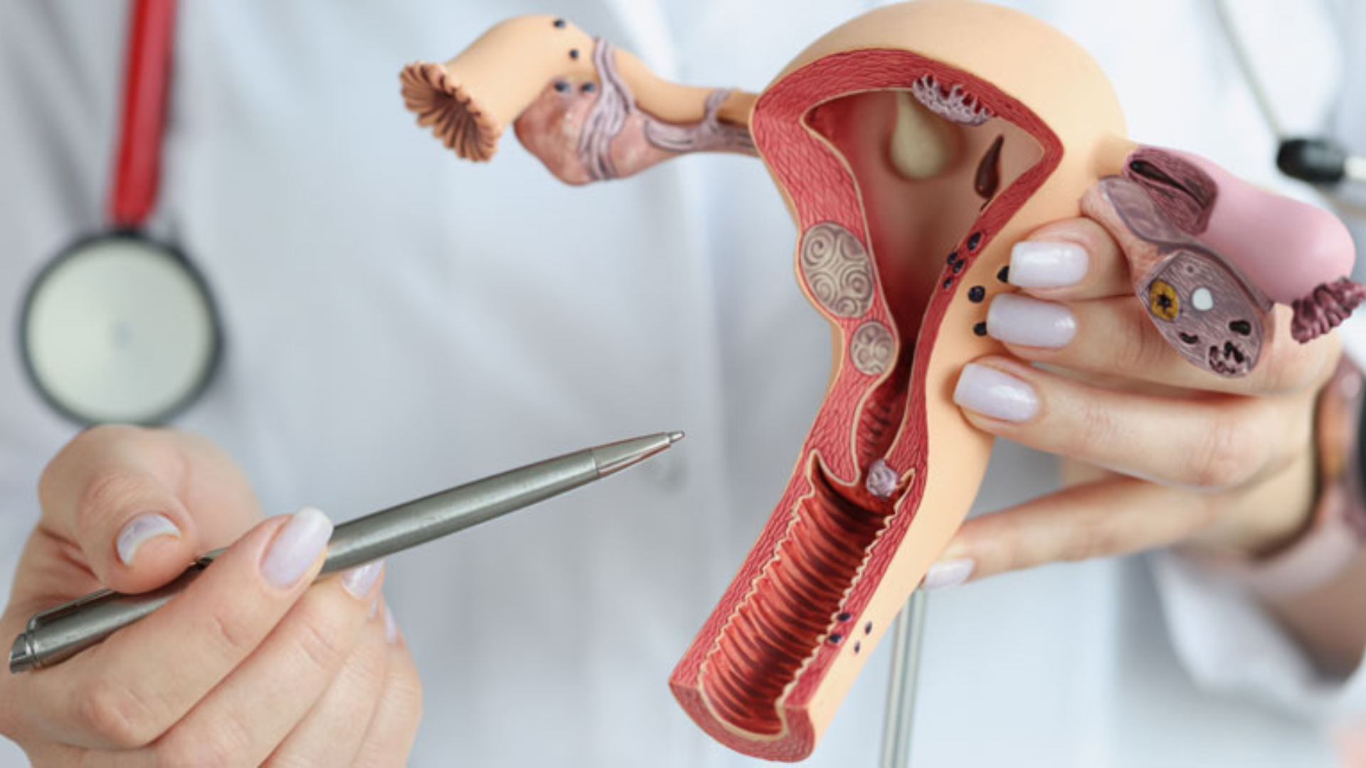 Nang Naboth là những túi nhỏ chứa dịch nhầy, hình thành dần khi tuyến nhầy cổ tử cung tắc nghẽn