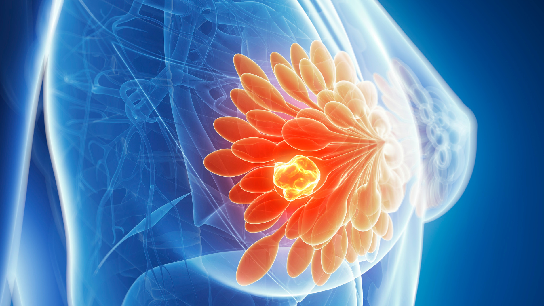 Nang vú là gì là vấn đề nhiều chị em quan tâm