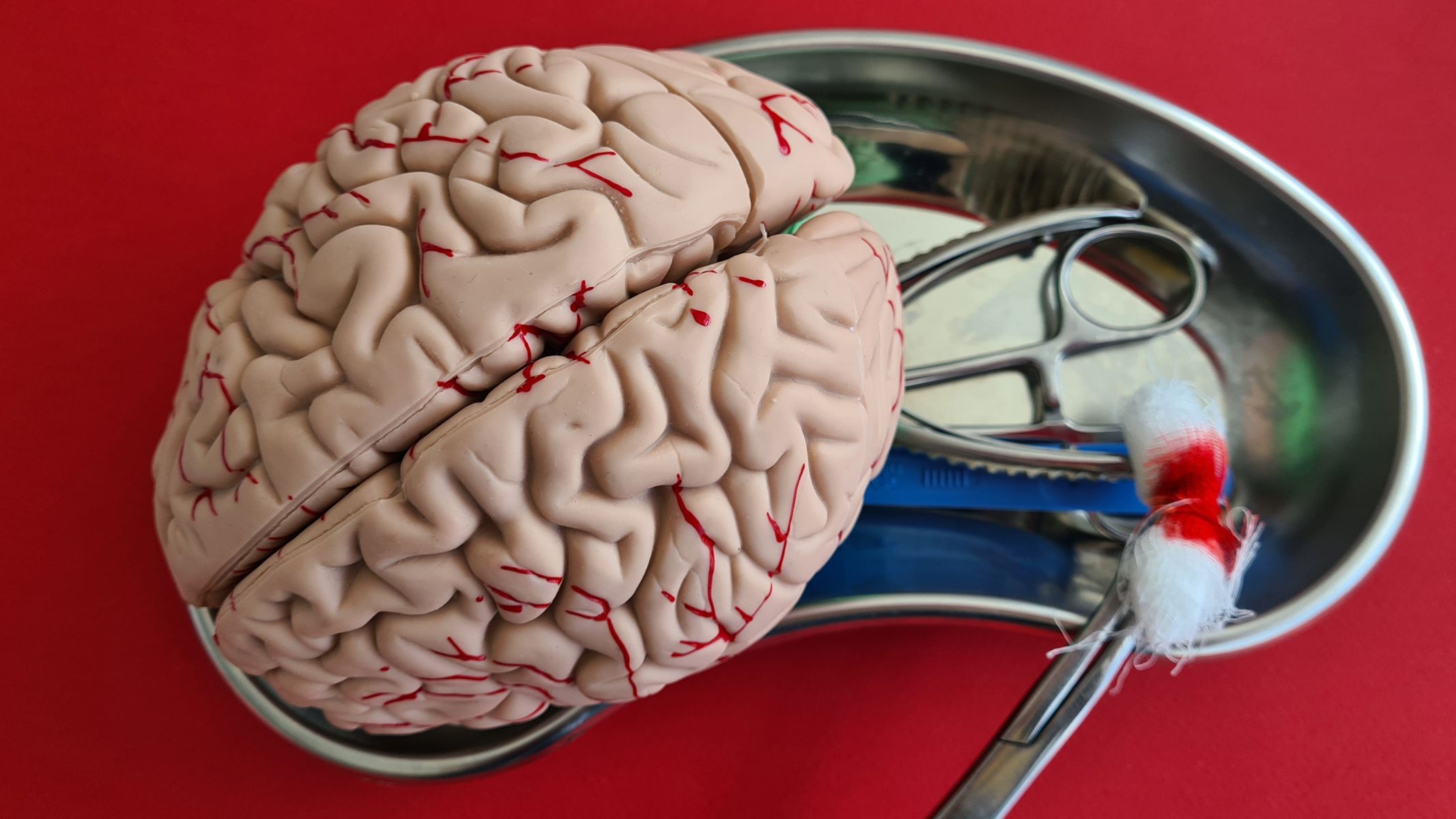 Não úng thủy (Hydrocephalus): Những điều bạn cần biết 1