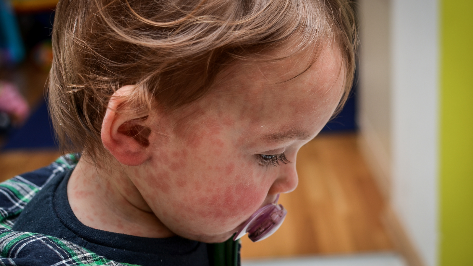 Hỗ trợ điều trị bệnh sởi ở trẻ em