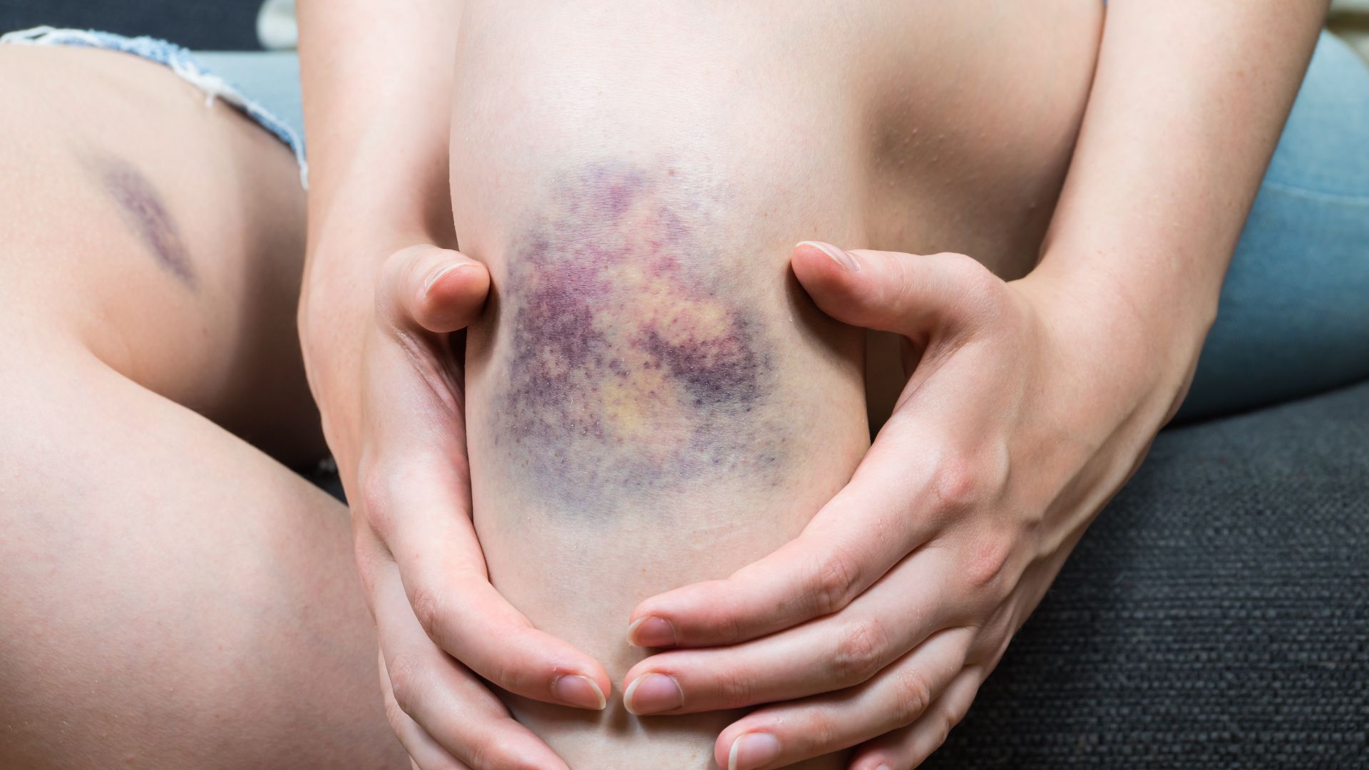 Vết bầm hình thành khi mạch máu dưới da bị vỡ do va chạm mạnh