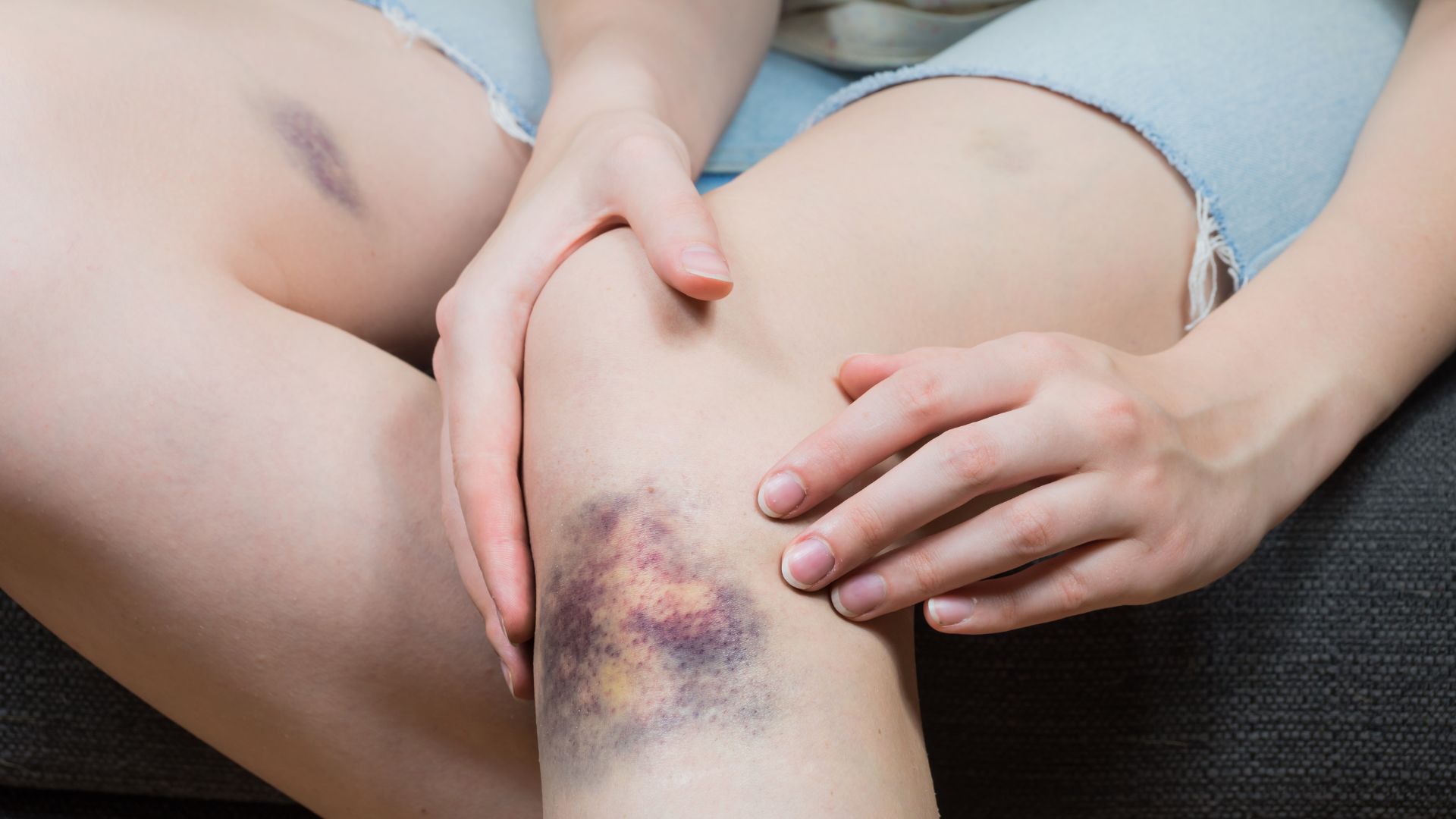 Màu sắc vết bầm thay đổi theo từng giai đoạn hồi phục của mô mềm