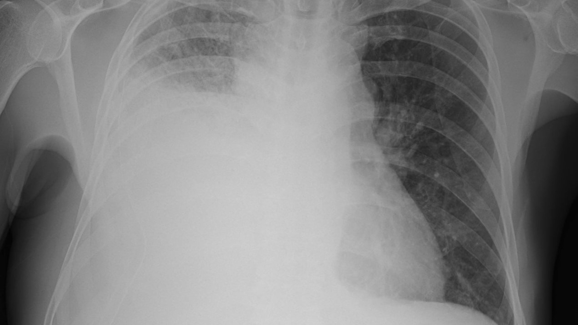 Khi nghe thấy âm thở giảm hoặc mất, có thể do tràn dịch màng phổi, tràn khí màng phổi