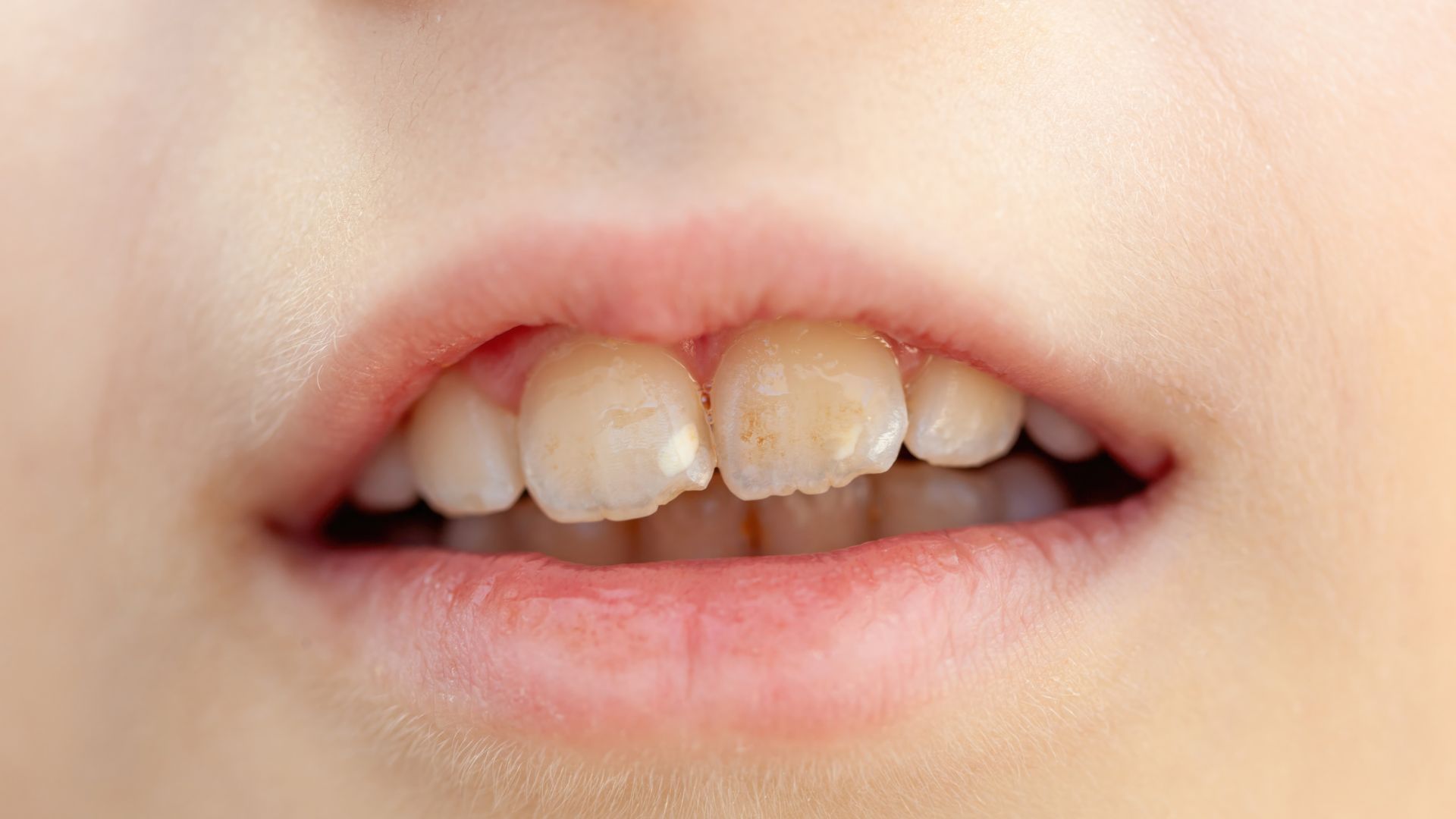 Cha mẹ nên đưa trẻ đi khám nếu tình trạng nghiến răng kéo dài và gây tổn thương răng