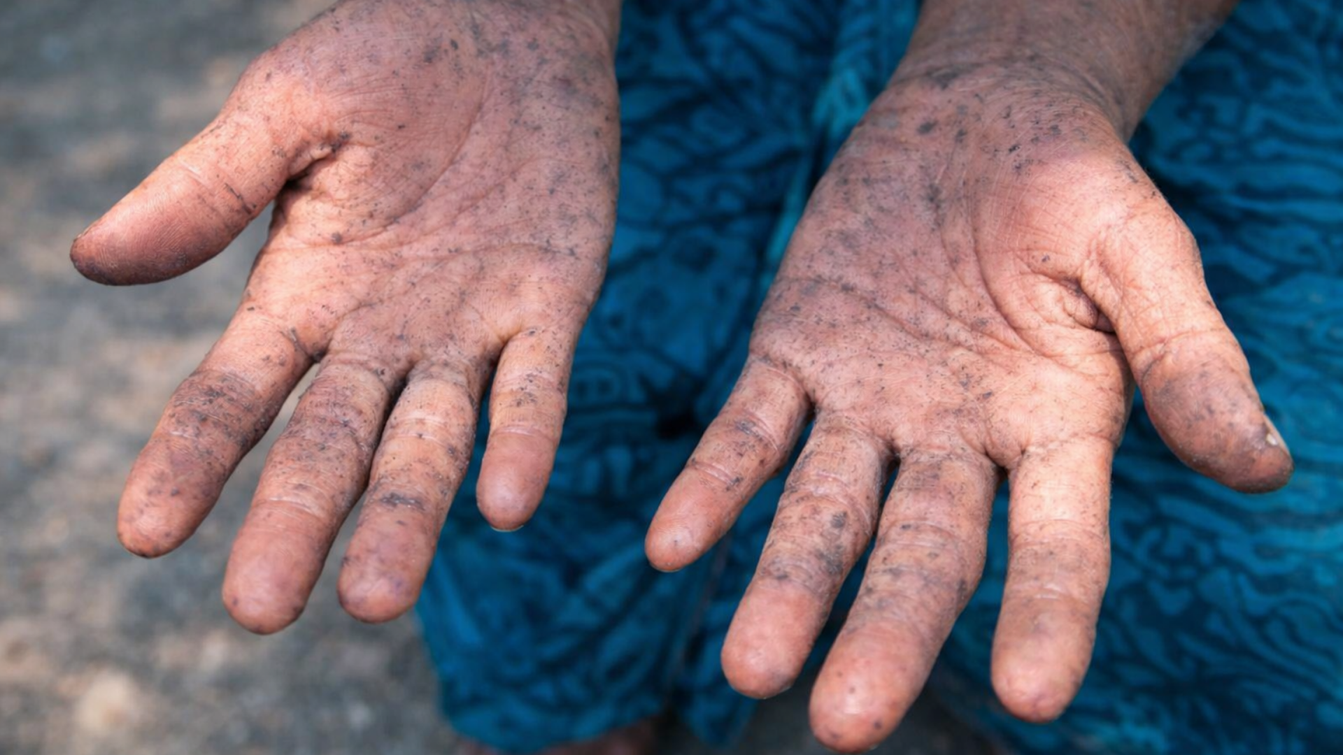 Tổng quan về ngộ độc arsenic và tác động của thạch tín