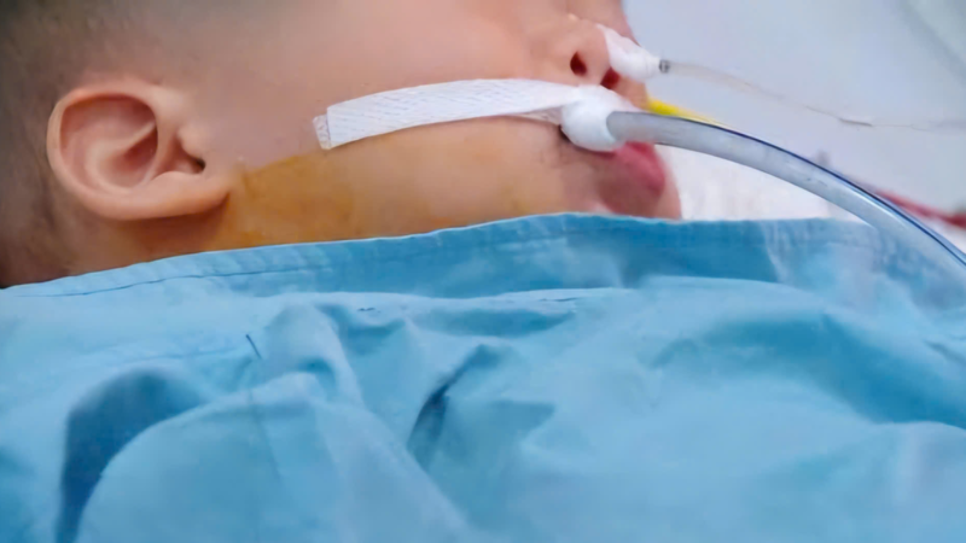 Bé 19 tháng tuổi nhập viện vì suy hô hấp nặng, rối loạn chuyển hóa và phải thở máy