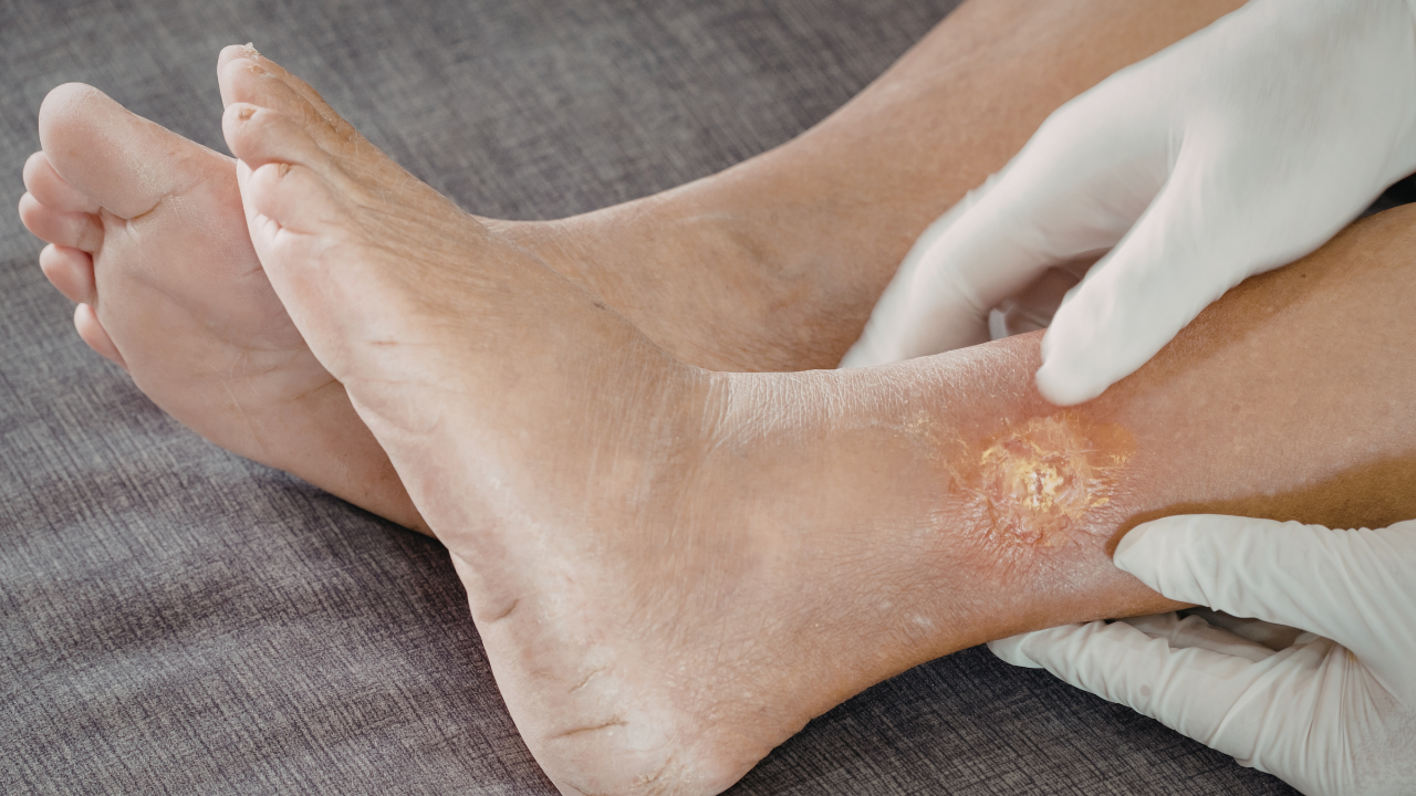 Biến chứng tiểu đường ảnh hưởng đến khớp cổ chân và lưu thông máu