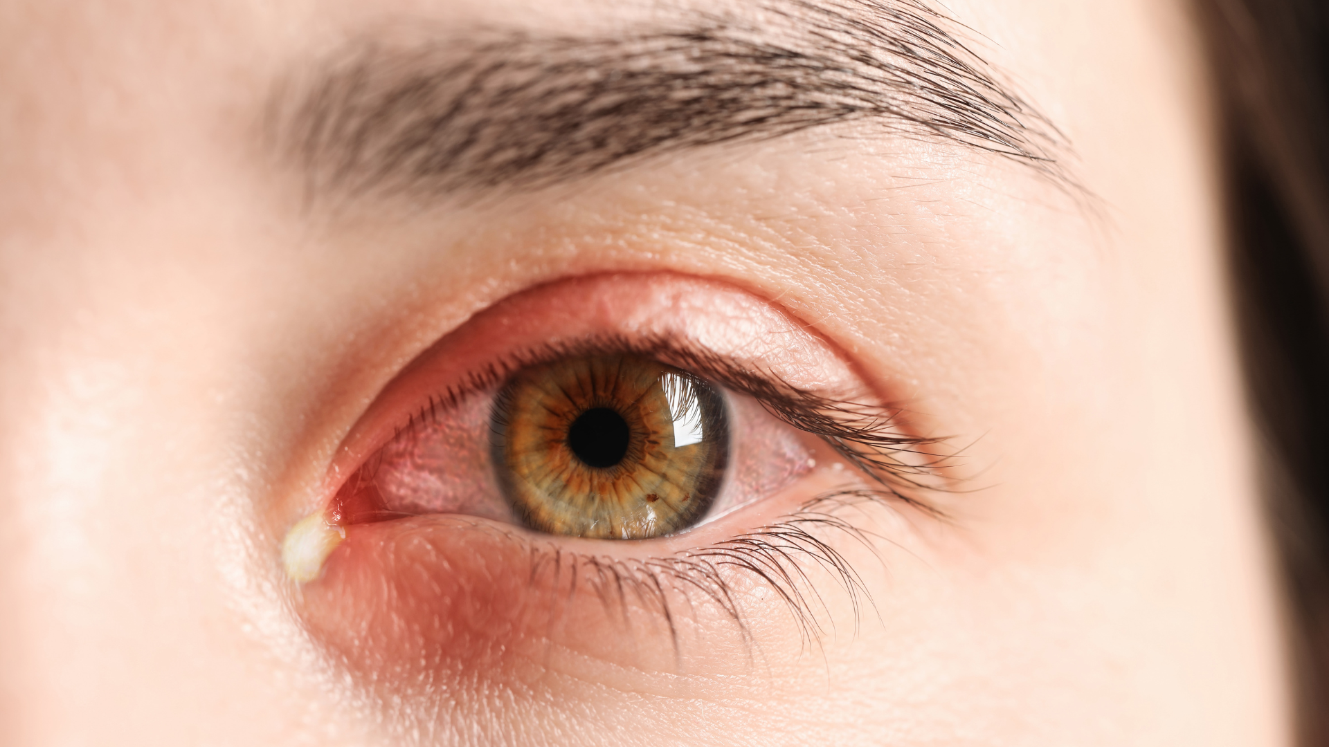 Ngứa khóe mắt kéo dài cần được theo dõi y tế