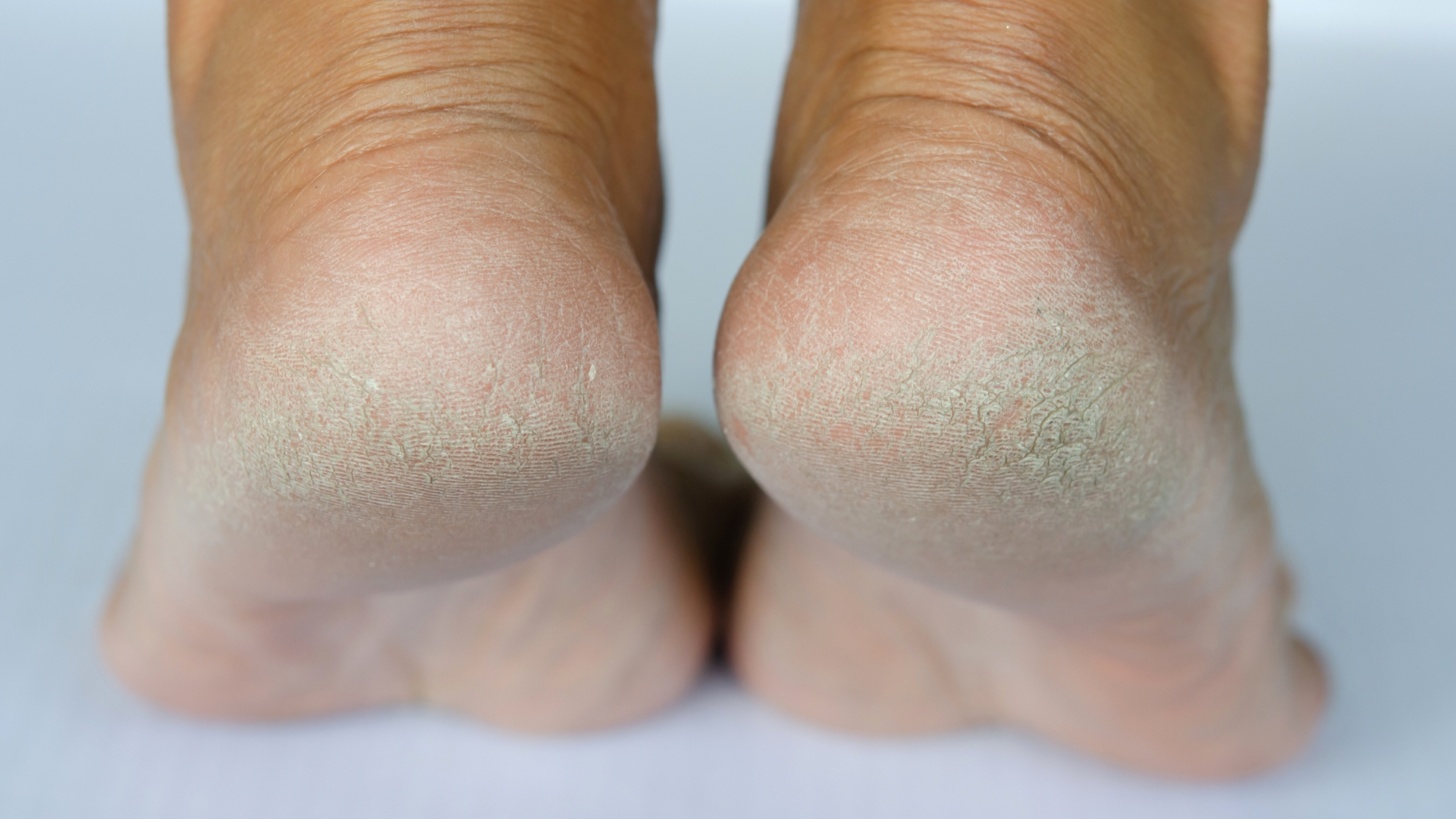 Một trong những nguyên nhân phổ biến nhất gây ngứa lòng bàn chân là do da khô. Khi lớp biểu bì thiếu nước, da trở nên thô ráp, bong tróc và dễ kích ứng