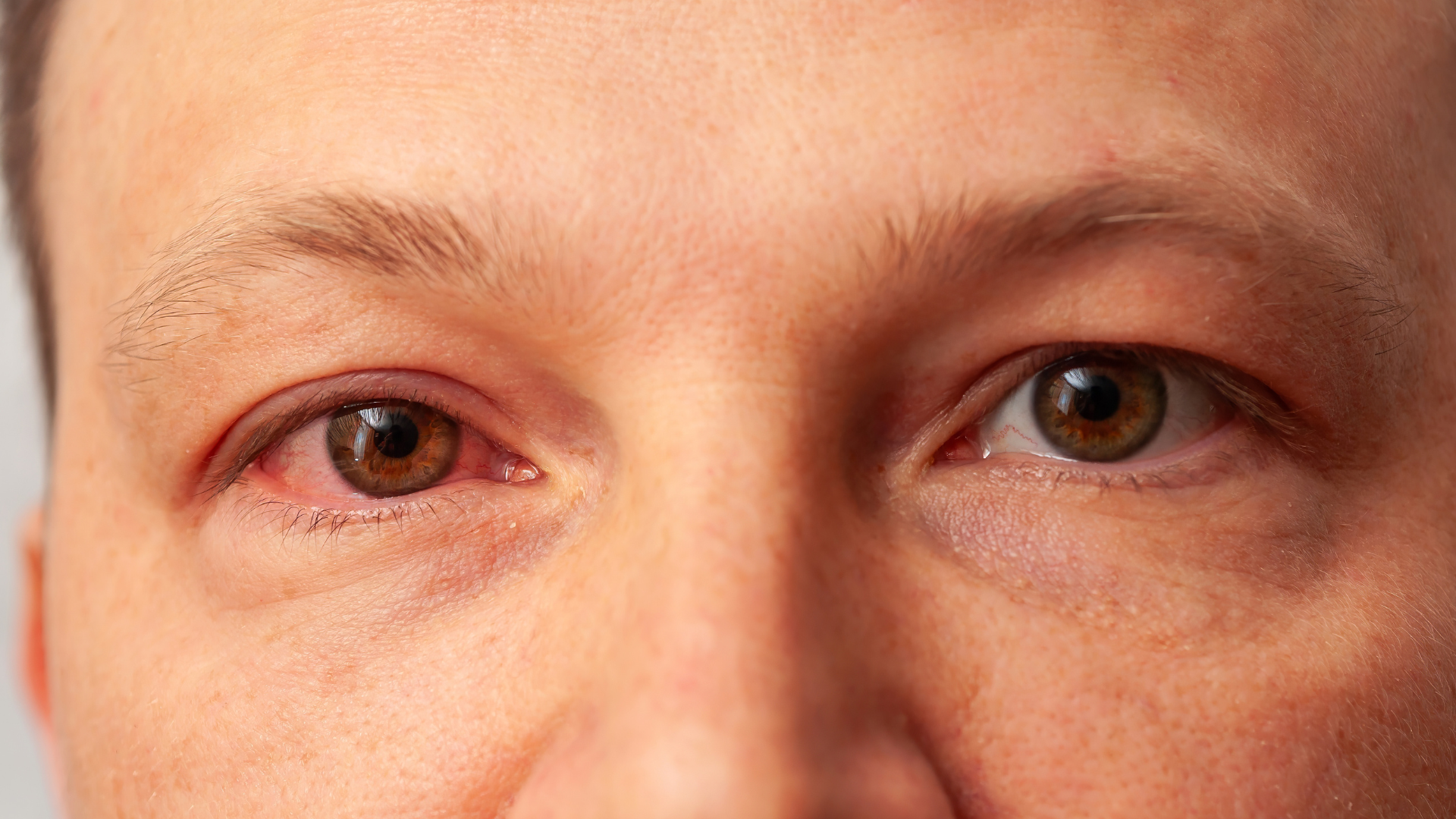 Ngứa mắt trái kèm dấu hiệu bất thường cần đi khám sớm