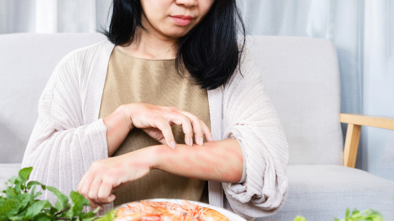 Ngứa nổi mề đay toàn thân có nguy hiểm không? Cách điều trị 2