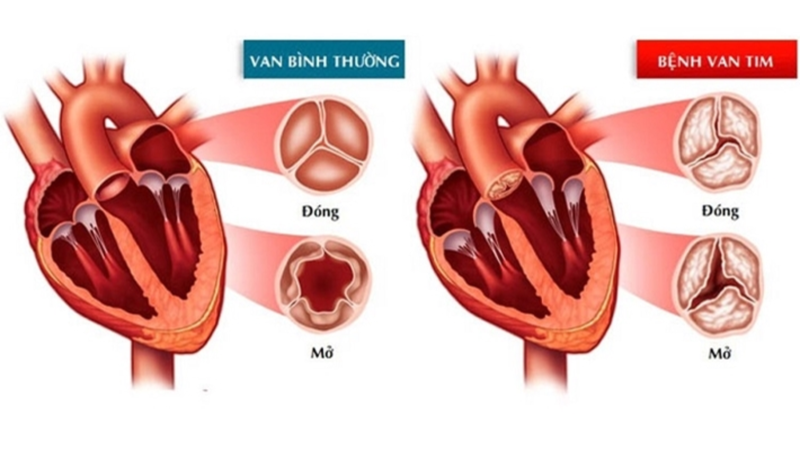 Hở van tim tác động đến sức khỏe theo nhiều mức độ khác nhau