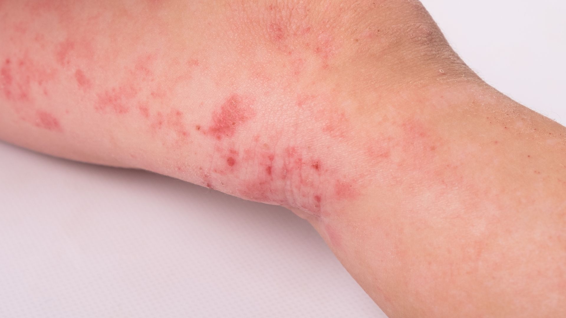 Người bị lupus ban đỏ có nên lấy chồng không? Bị lupus ban đỏ cần lưu ý gì khi mang thai? 1