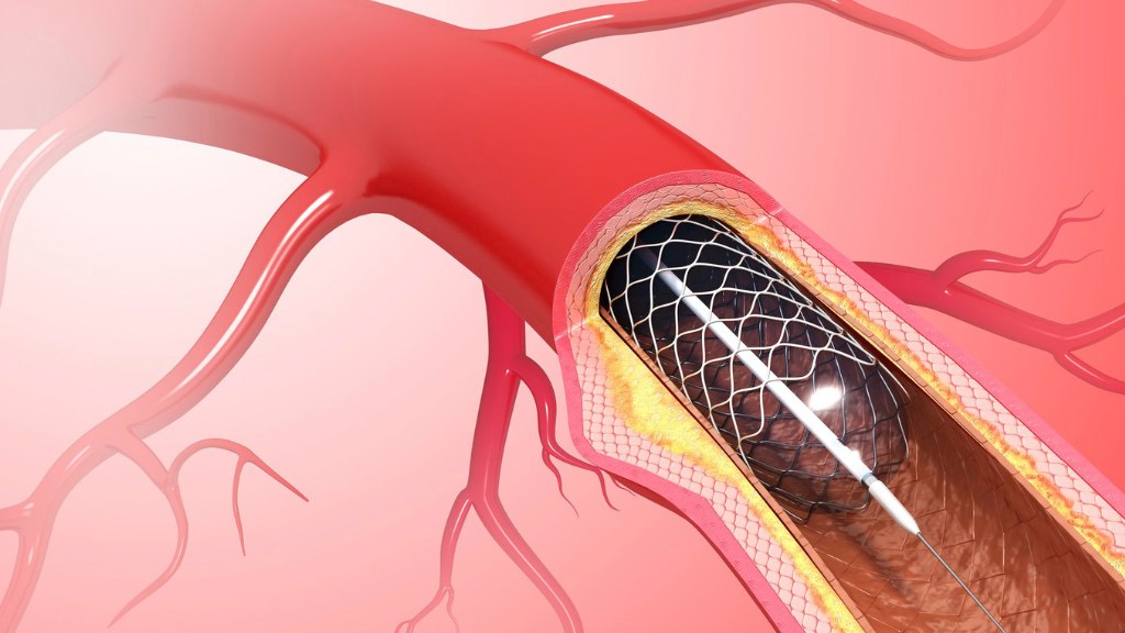 Người đặt stent mạch vành sống được bao lâu?