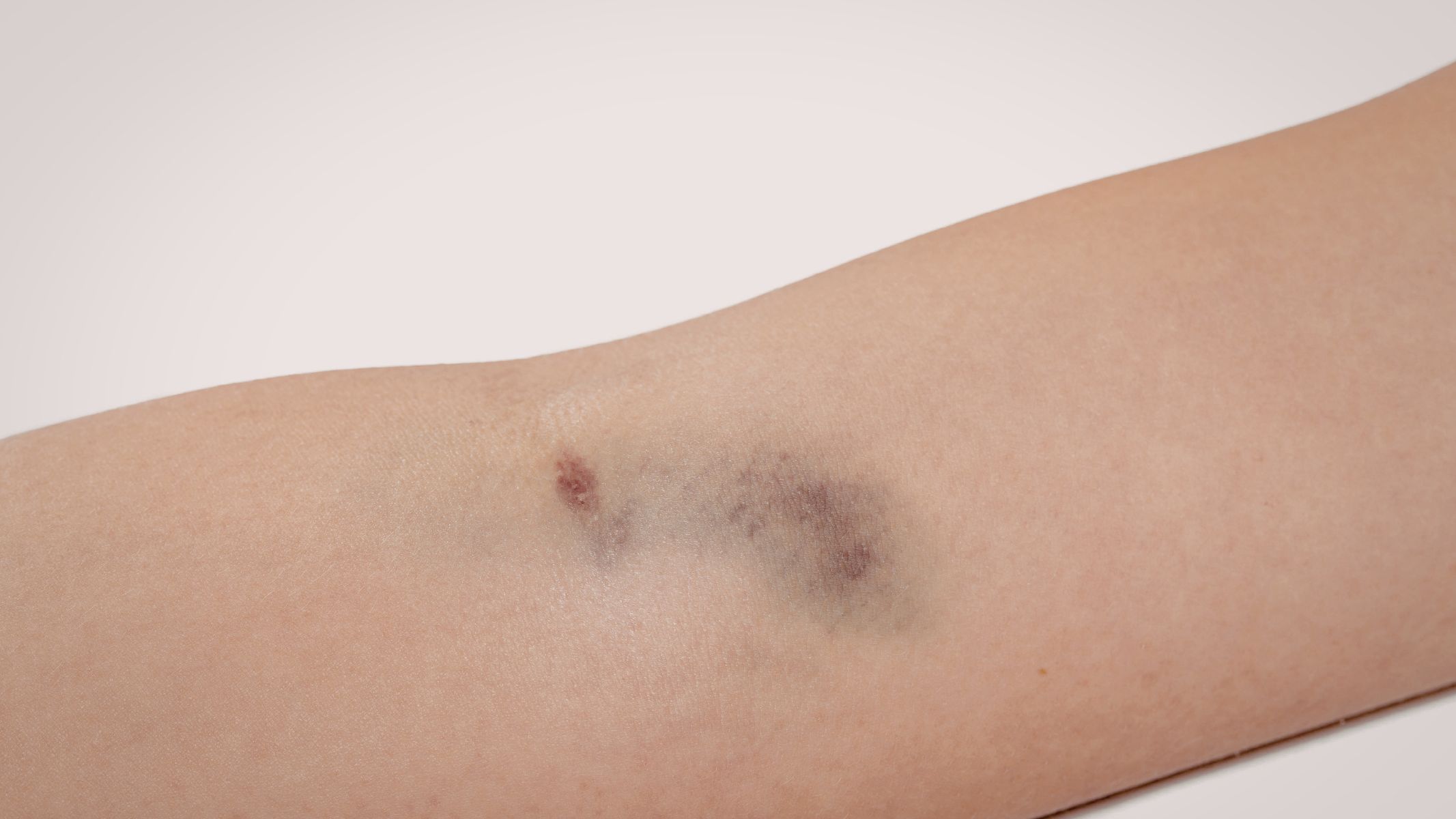 Người bệnh dễ xuất hiện các mảng bầm tím dưới da mà không rõ nguyên nhân