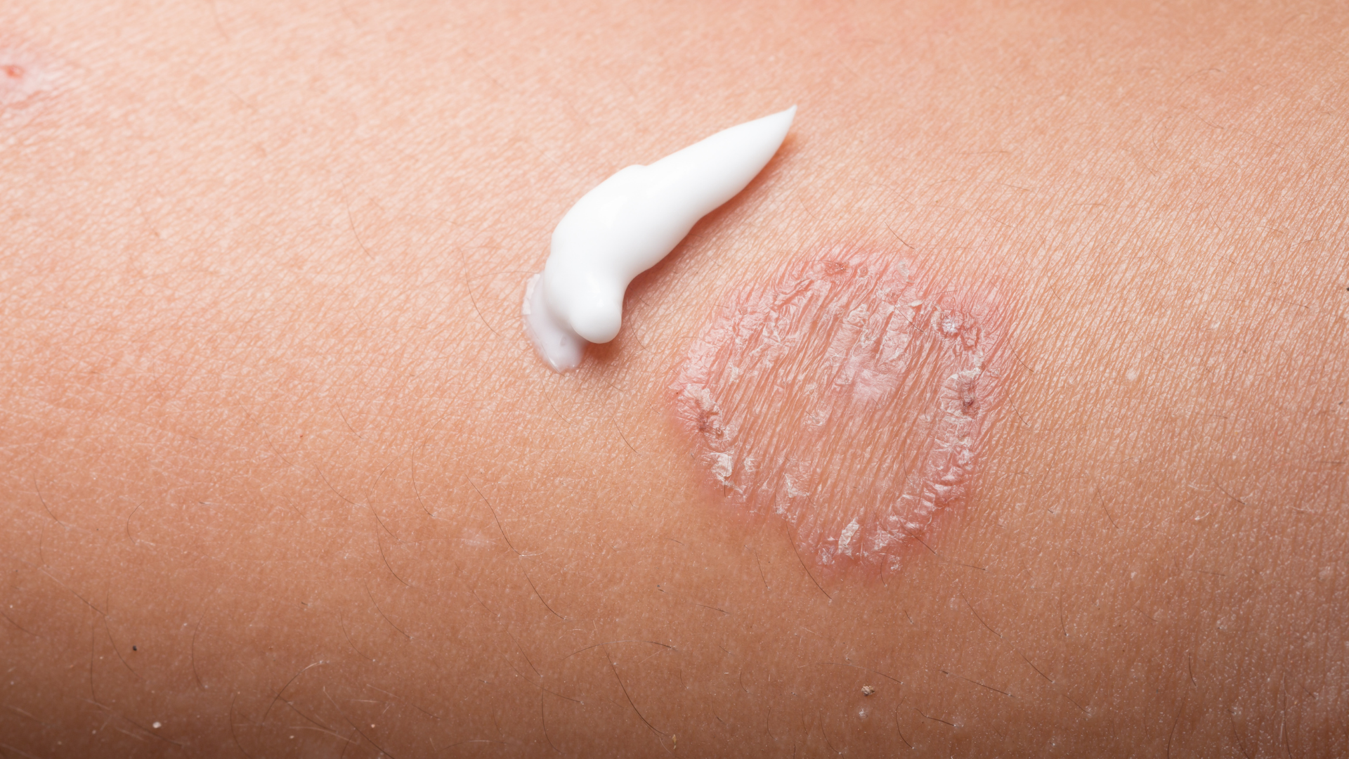 Khí hậu nóng ẩm tại Việt Nam là yếu tố thuận lợi gây bệnh hắc lào