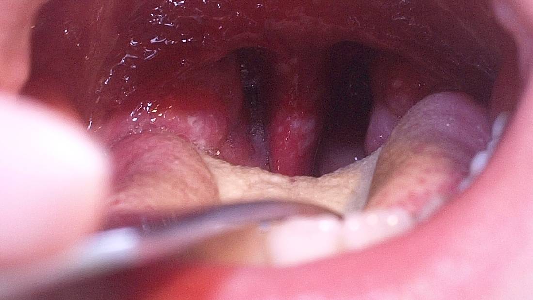 Nguyên nhân bị nấm lưỡi ở người lớn? Triệu chứng và biện pháp phòng ngừa 3