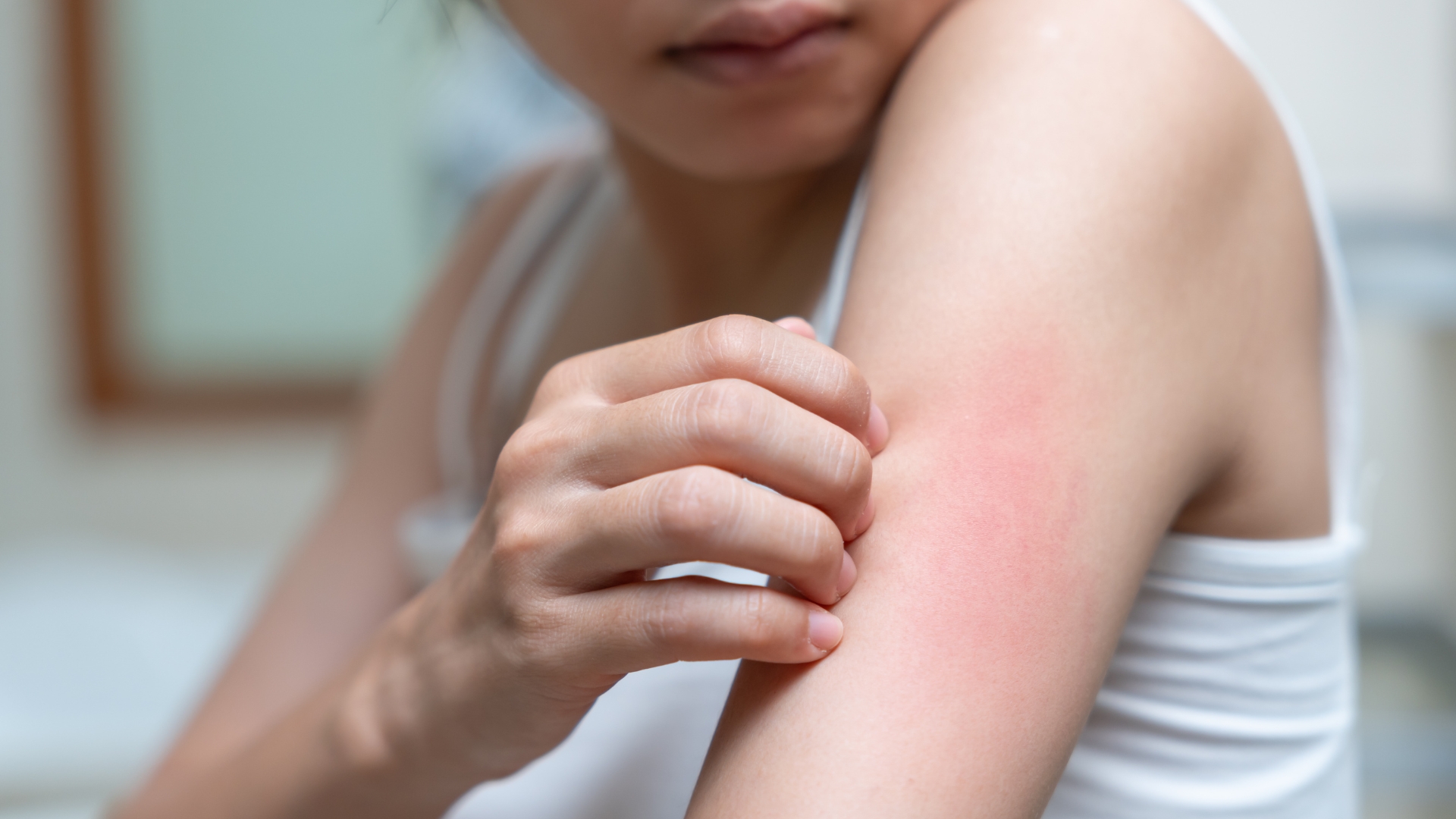 Nguyên nhân bị ngứa toàn thân càng gãi càng ngứa và cách khắc phục hiệu quả 1