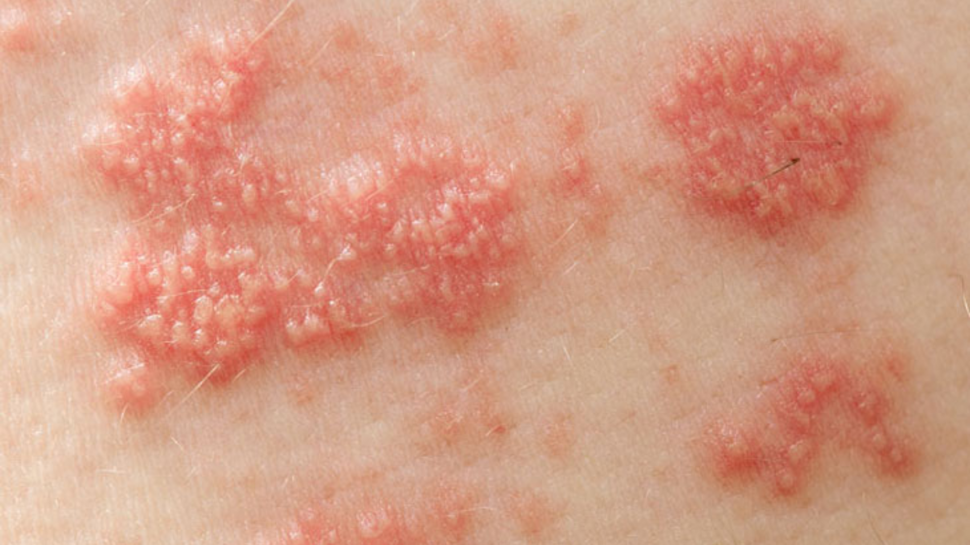 nguyen-nhan-bi-thuy-dau-va-cach-phong-ngua-hieu-qua-3