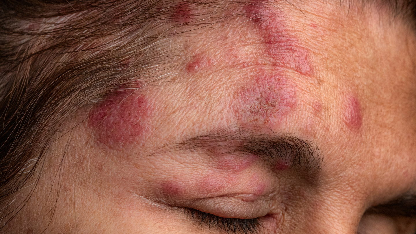 nguyen-nhan-bi-zona-than-kinh-ma-ban-can-biet 3.png