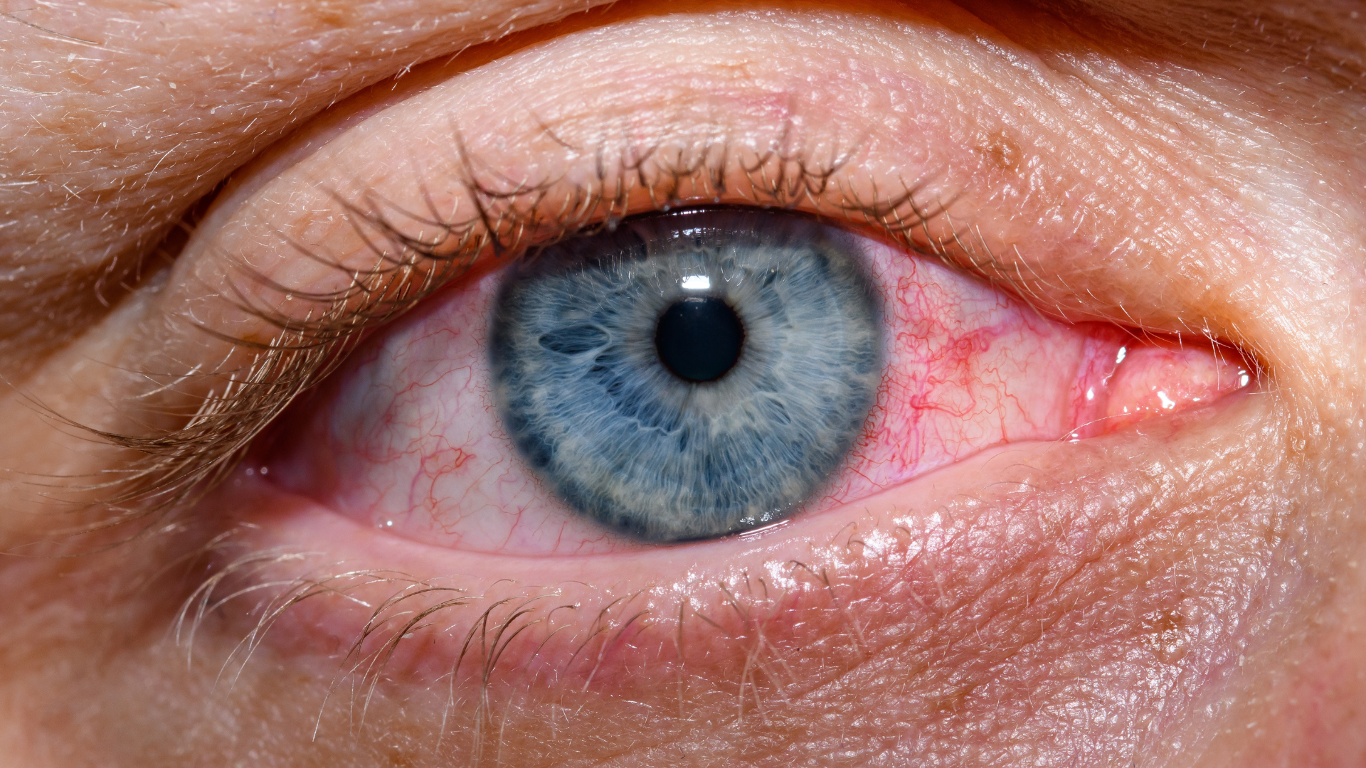 nguyen-nhan-dan-den-mat-bi-do-va-phuong-phap-dieu-tri-khi-bi-do-mat 1.png