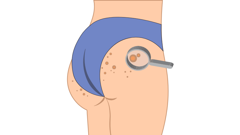 8 cách trị mụn nhọt ở mông và những lưu ý quan trọng 1