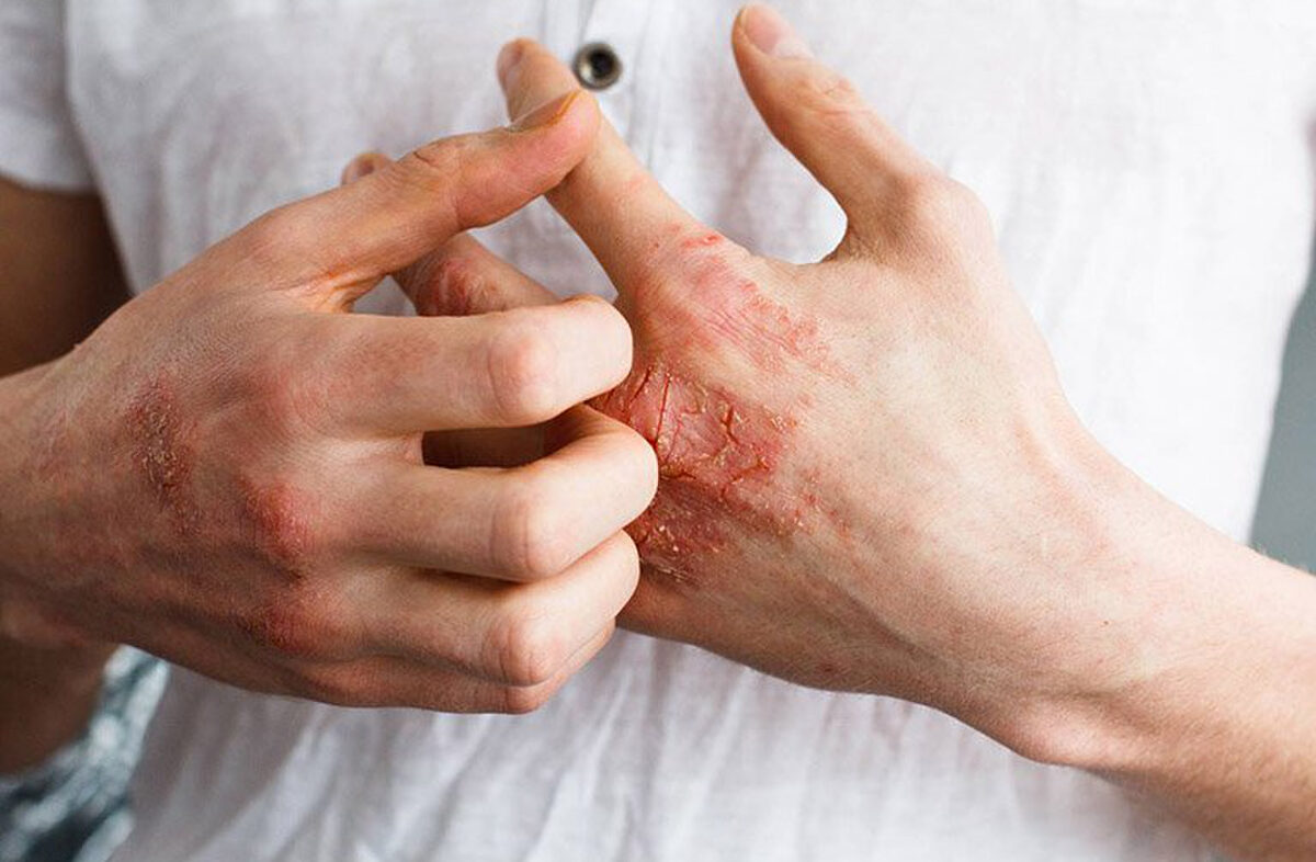 nguyen-nhan-gay-benh-truyen-nhiem-nhom-c-ban-can-luu-y 2.jpg