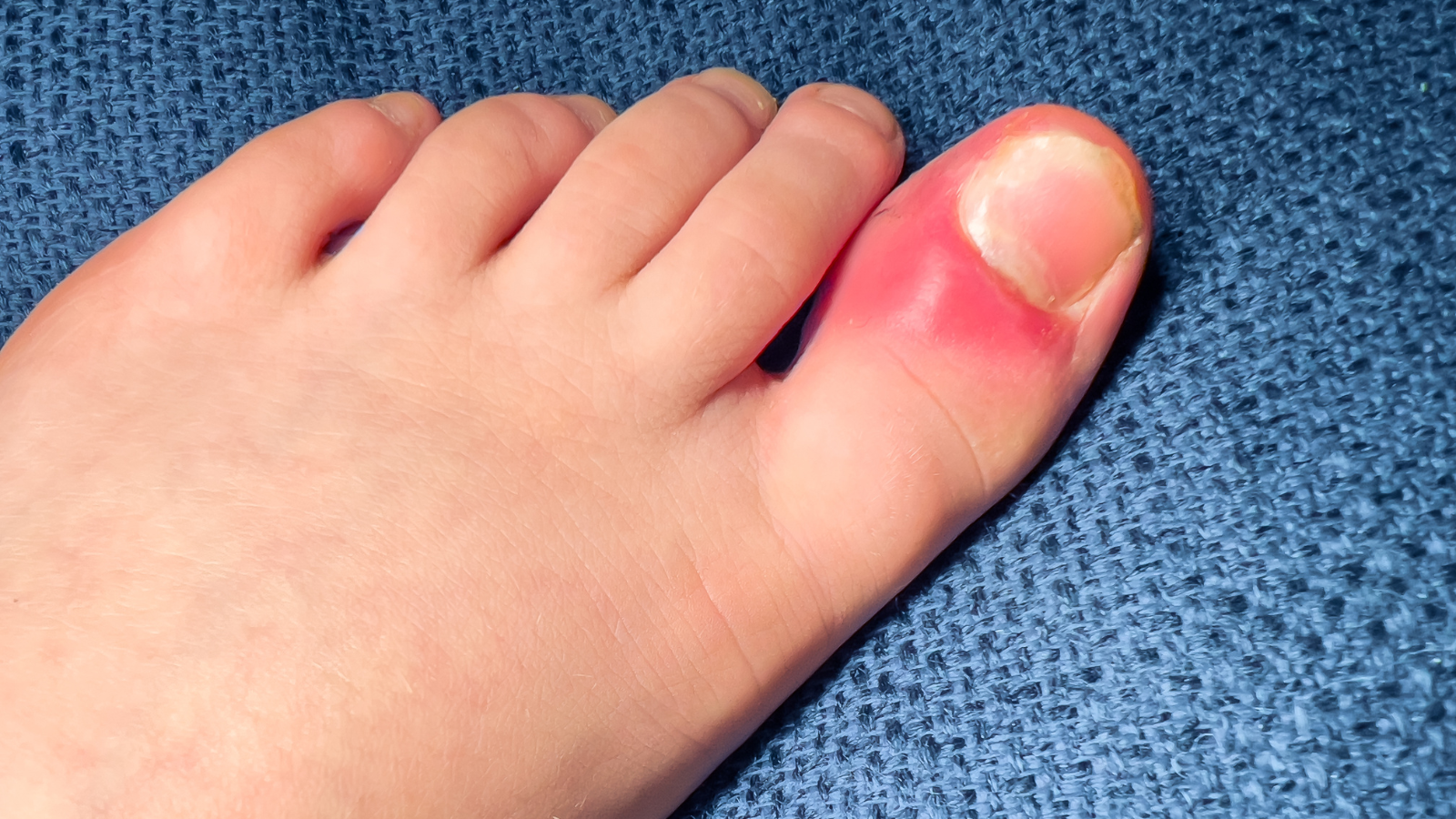 Viêm xương vừng có thể gây đau ngón chân cái