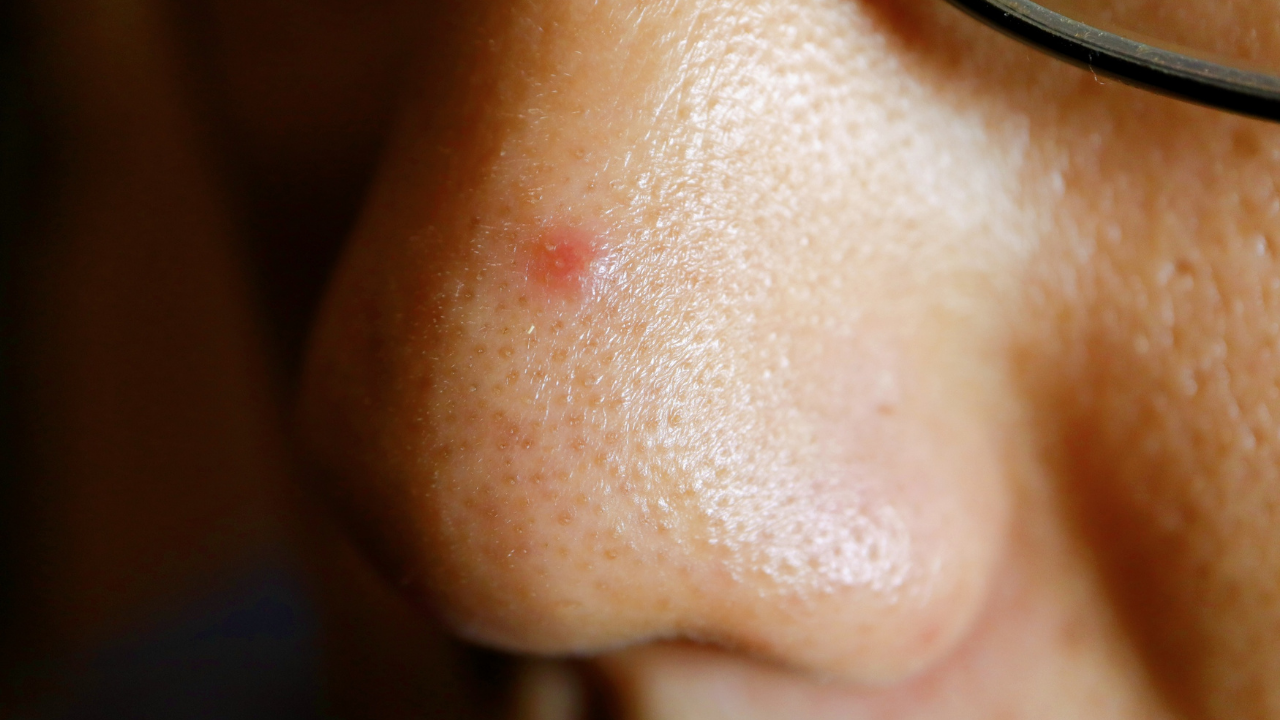 Giãn mao mạch mũi không phải là mụn đỏ