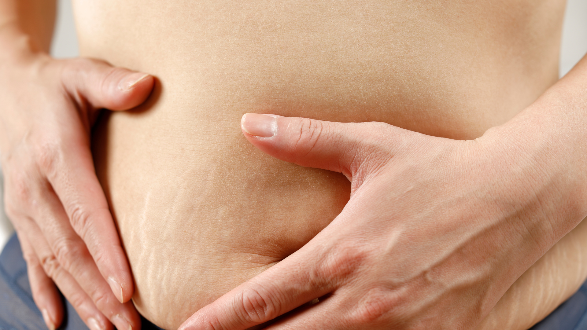 Rạn da xuất hiện chủ yếu ở những vùng da căng giãn mạnh