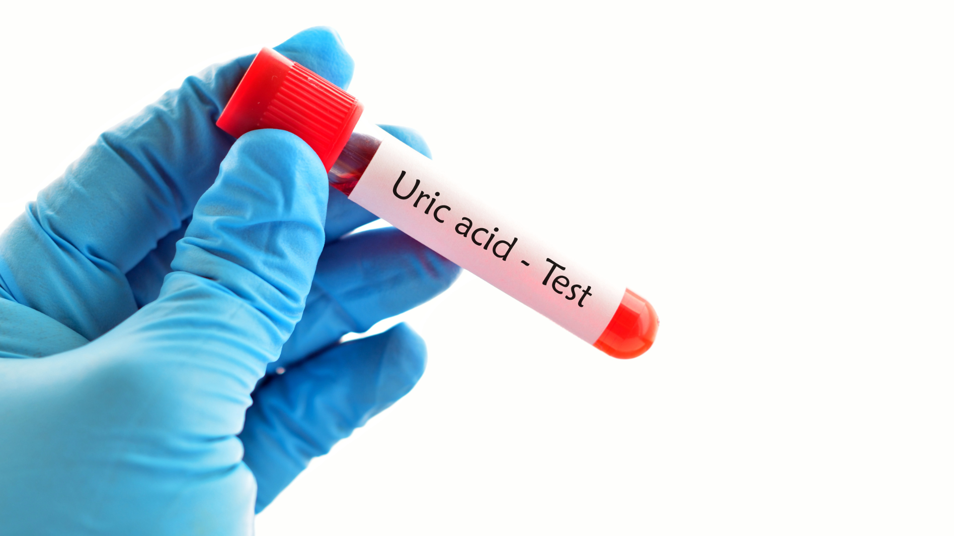Tăng axit uric máu là tình trạng nồng độ axit uric trong máu vượt quá ngưỡng bình thường, được xác định qua xét nghiệm sinh hóa