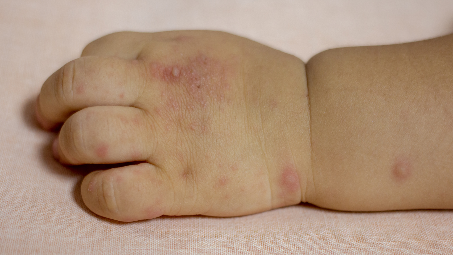 Trẻ bị tay chân miệng có mụn nước ngứa kèm sốt cao, co giật, khó thở cần được đưa đi khám ngay vì đây là dấu hiệu nặng