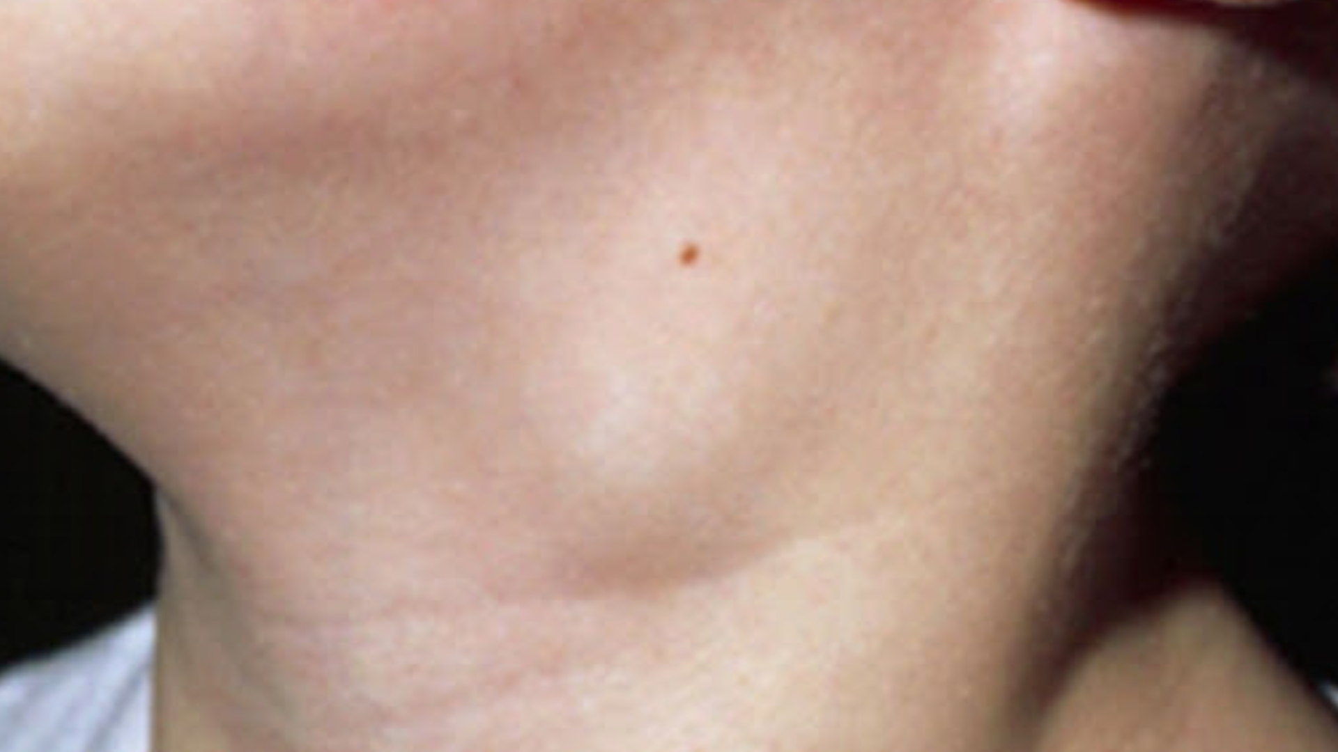 U lympho lành tính ít nguy hiểm nhưng cần theo dõi để phòng tiến triển ác tính