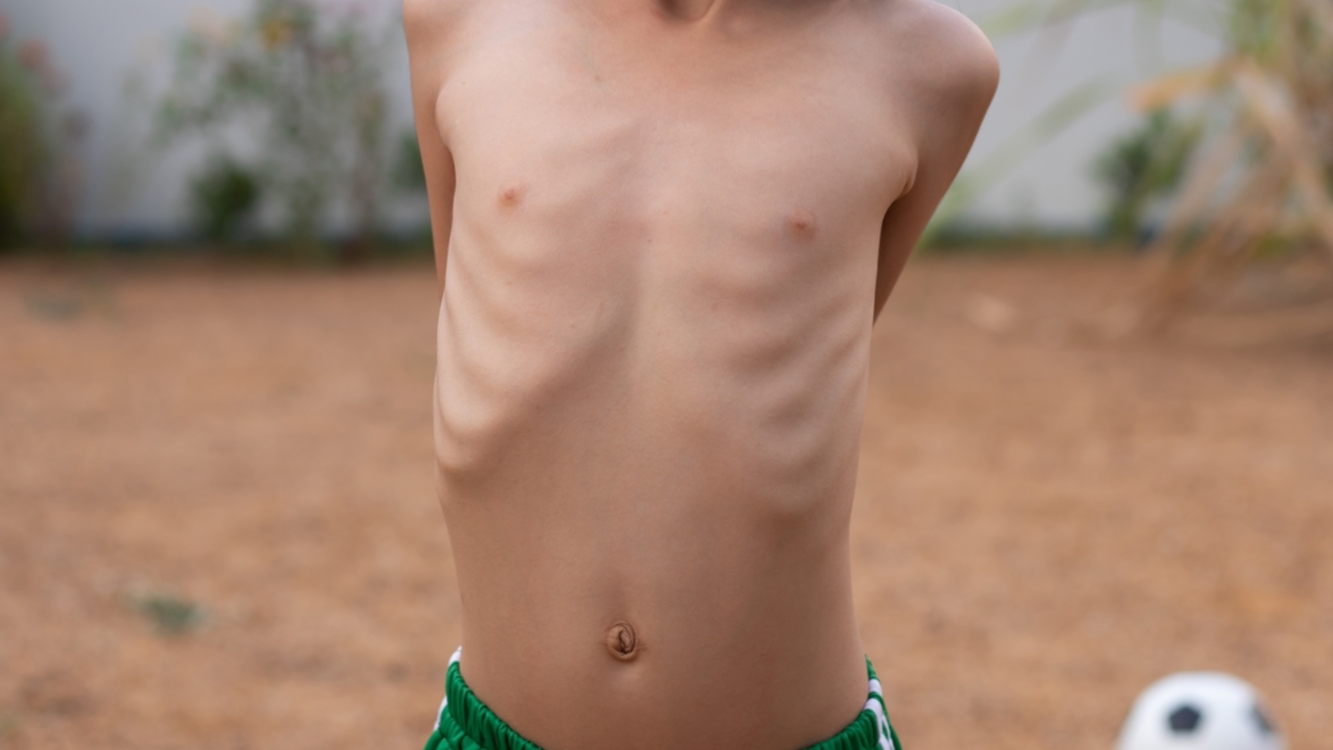 Suy dinh dưỡng do ăn uống kém là một trong những yếu tố làm gia tăng nguy cơ bệnh tật ở trẻ nhỏ