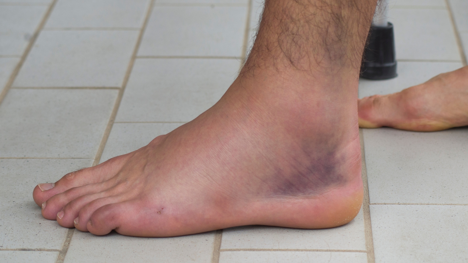 Vùng cổ chân bị trật sẽ sưng nhanh chóng do tổn thương mạch máu và mô mềm xung quanh