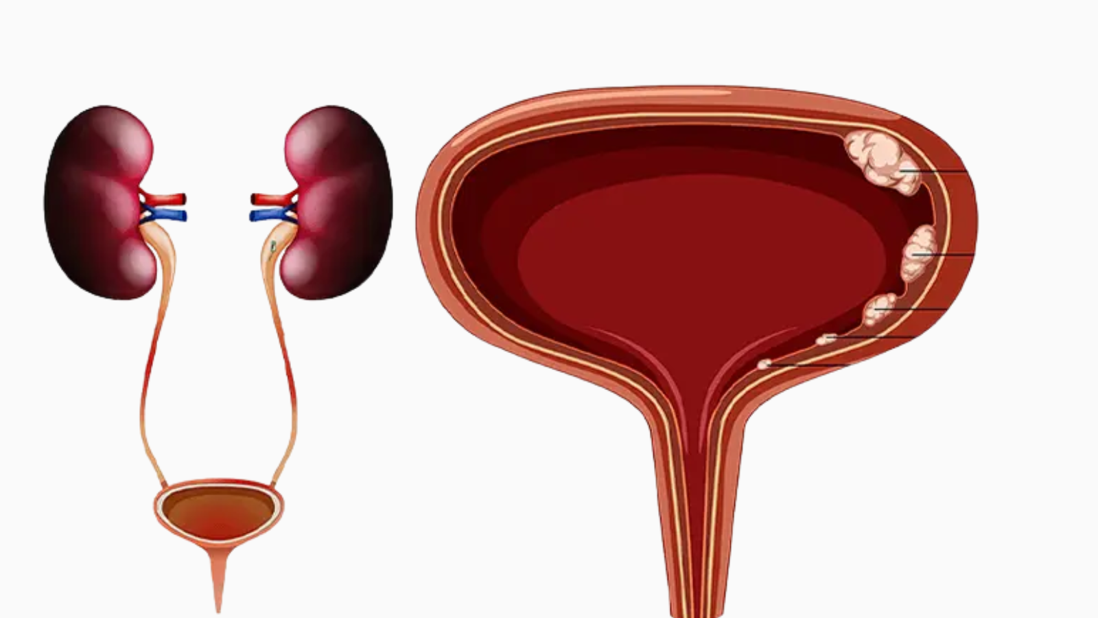 Ung thư bàng quangn có thể khiến nam giới tiểu ra máu