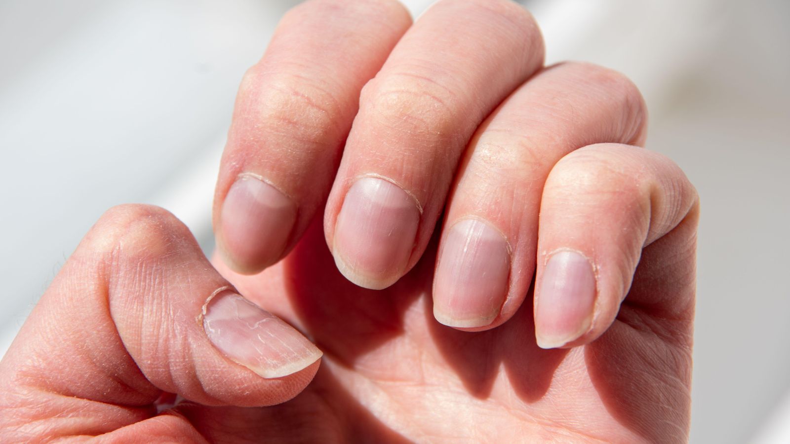 Nhận biết móng tay người bị HIV giai đoạn đầu