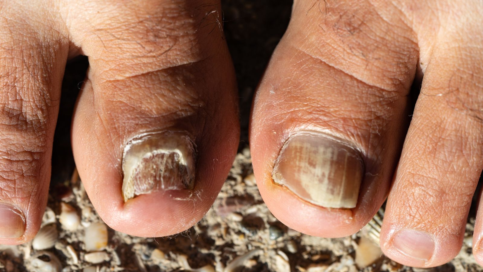 Bệnh nấm móng do nhiễm trùng cơ hội