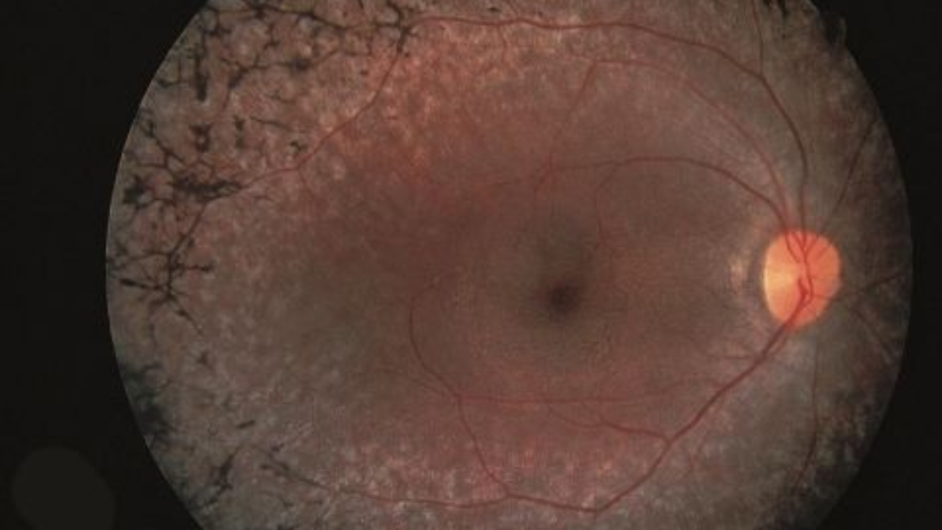 Viêm võng mạc sắc tố có tính di truyền gây thoái hóa dần các tế bào cảm nhận ánh sáng tại võng mạc