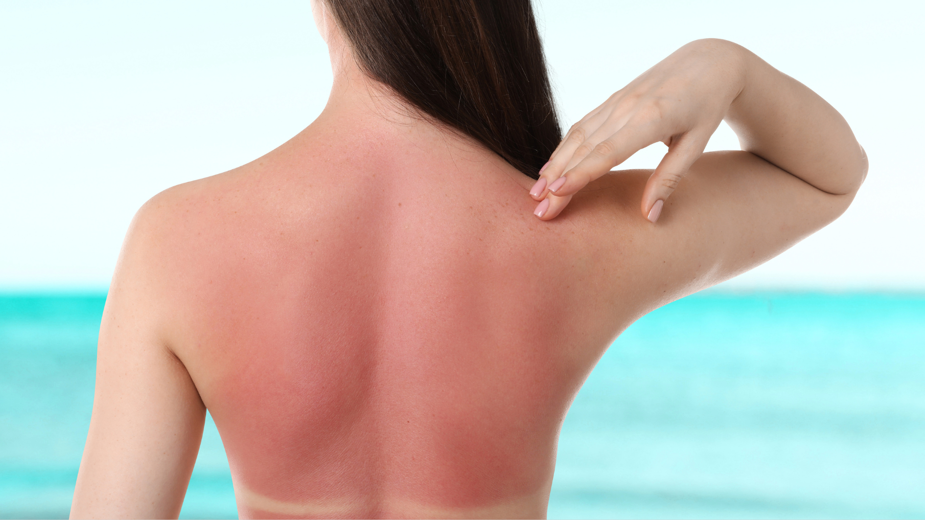 Nha đam giúp làm dịu vùng da bị bỏng do cháy nắng nhanh chóng