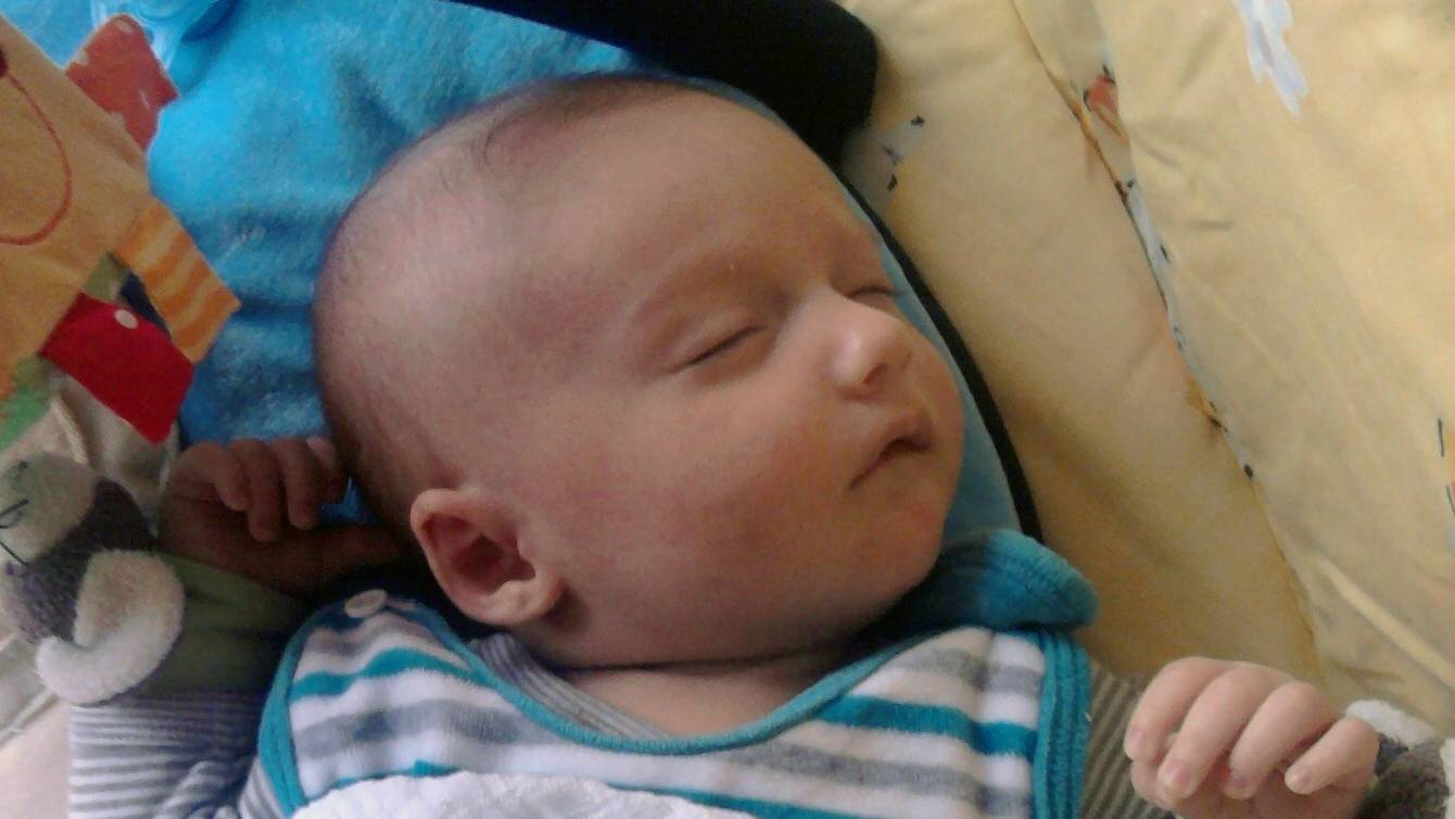 Phản ứng trên da là dấu hiệu điển hình của dị ứng thực phẩm ở trẻ nhỏ, gồm cả sữa công thức